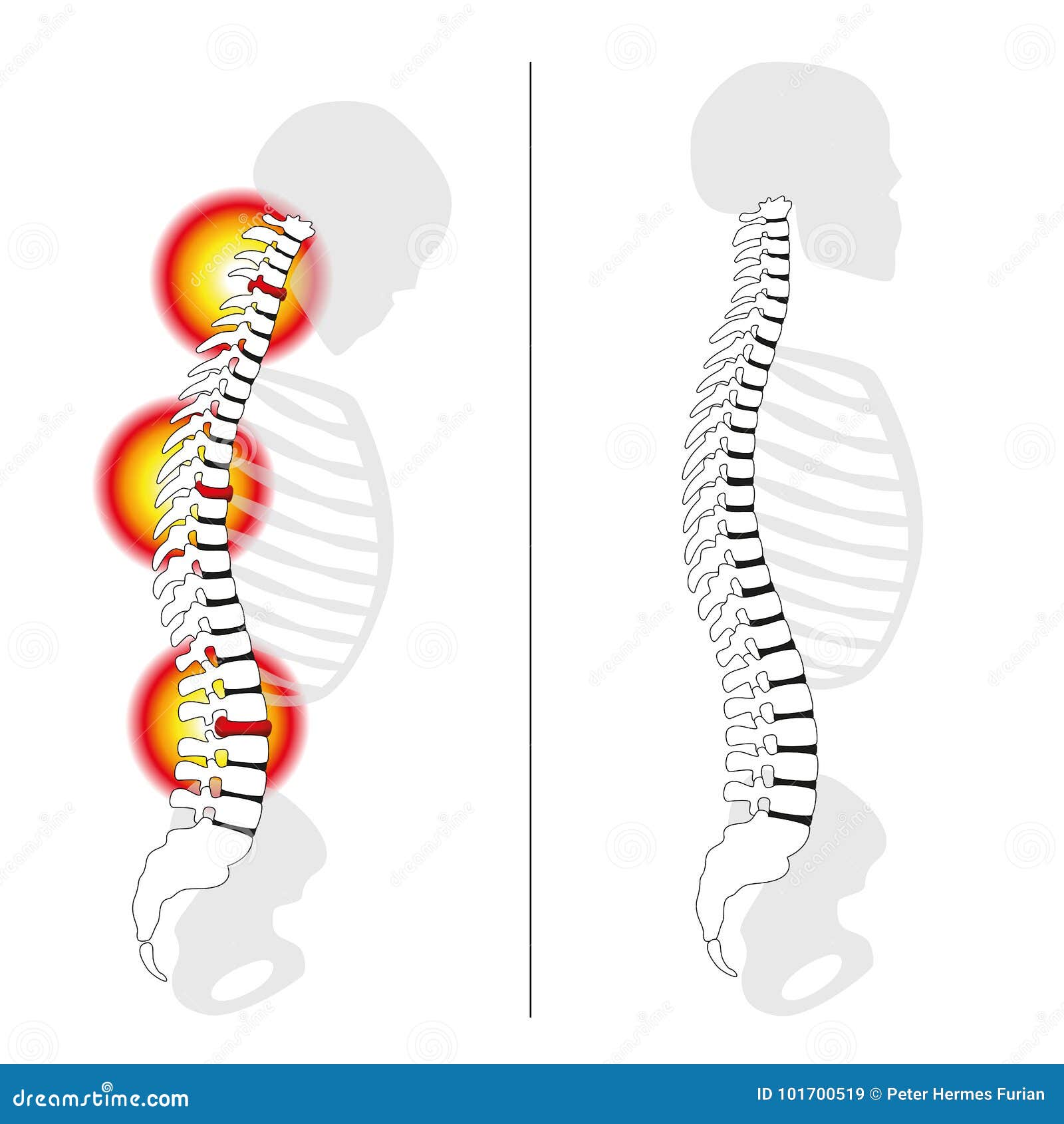 slipped disc prolapse back pain spine