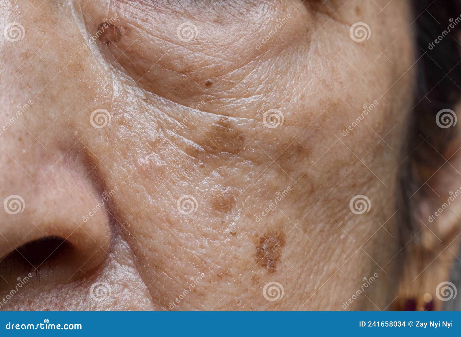 small brown patches called age spots on face of asian elder woman. they are also called liver spots, senile lentigo, or sun spots