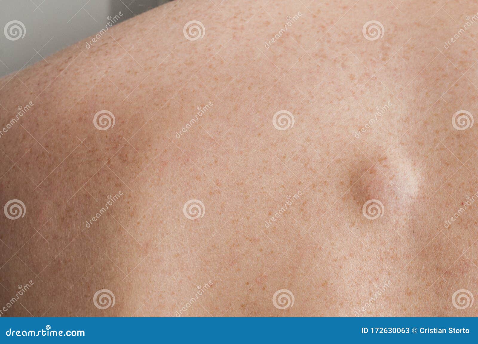 Lipoma Benign Growth Of Fatty Tissue Stock Photo