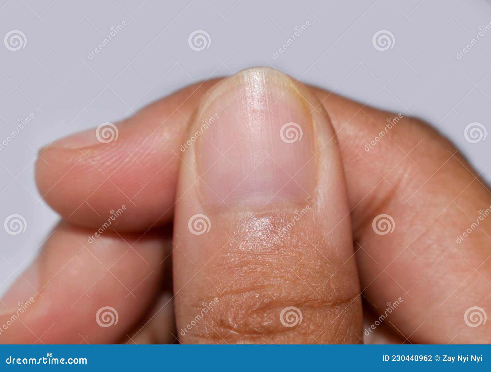 Vertical lines in fingernails hi-res stock photography and images - Alamy