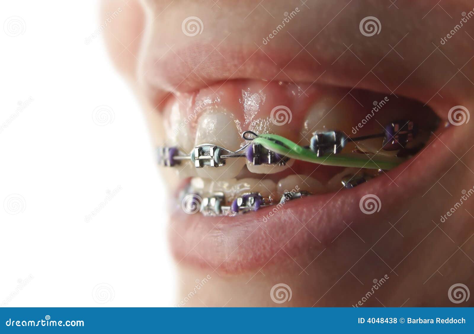 Smile With Braces Royalty Free Stock Photos Image 4048438
