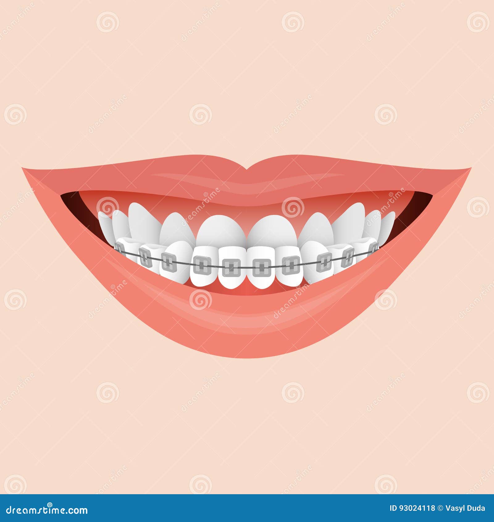Download Smile with Braces stock vector. Illustration of hygiene ...