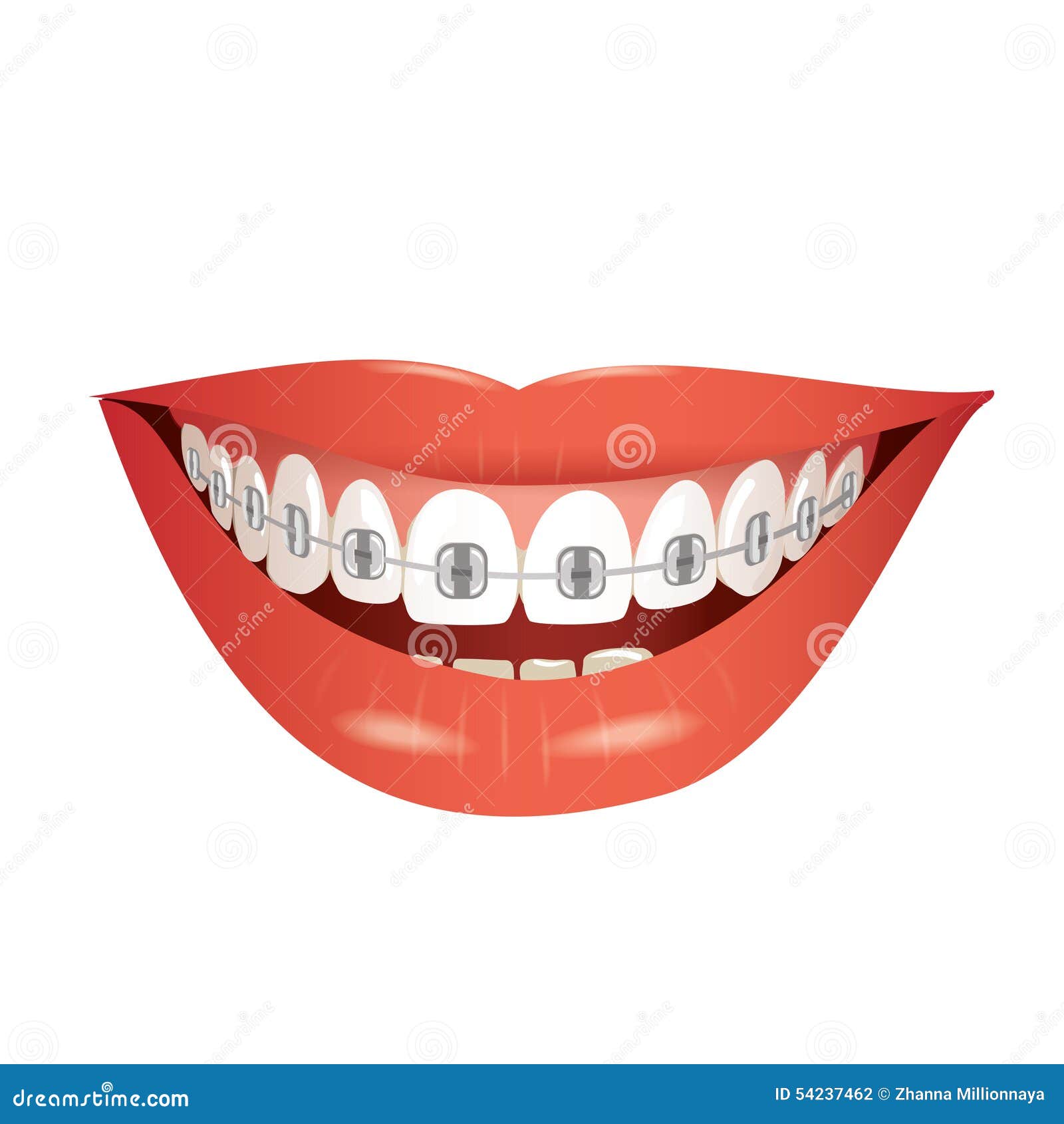 Smiling mouth with braces stock vector. Illustration of adult 54237462