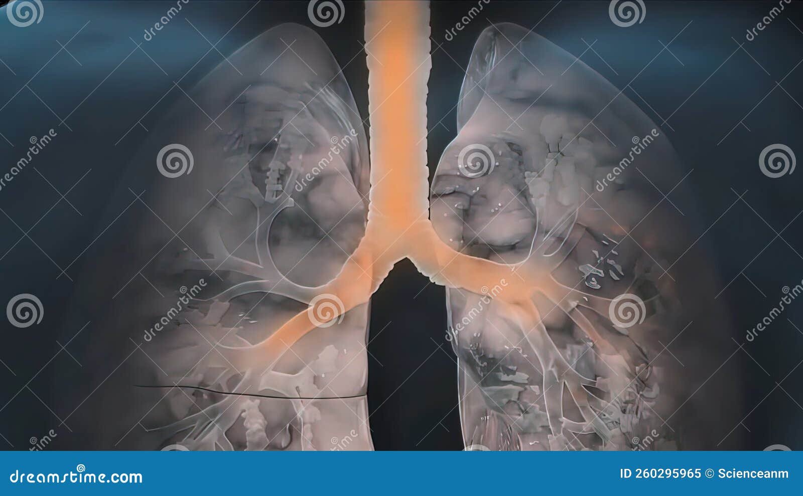 Smokers lung stock illustration. Illustration of primary 260295965
