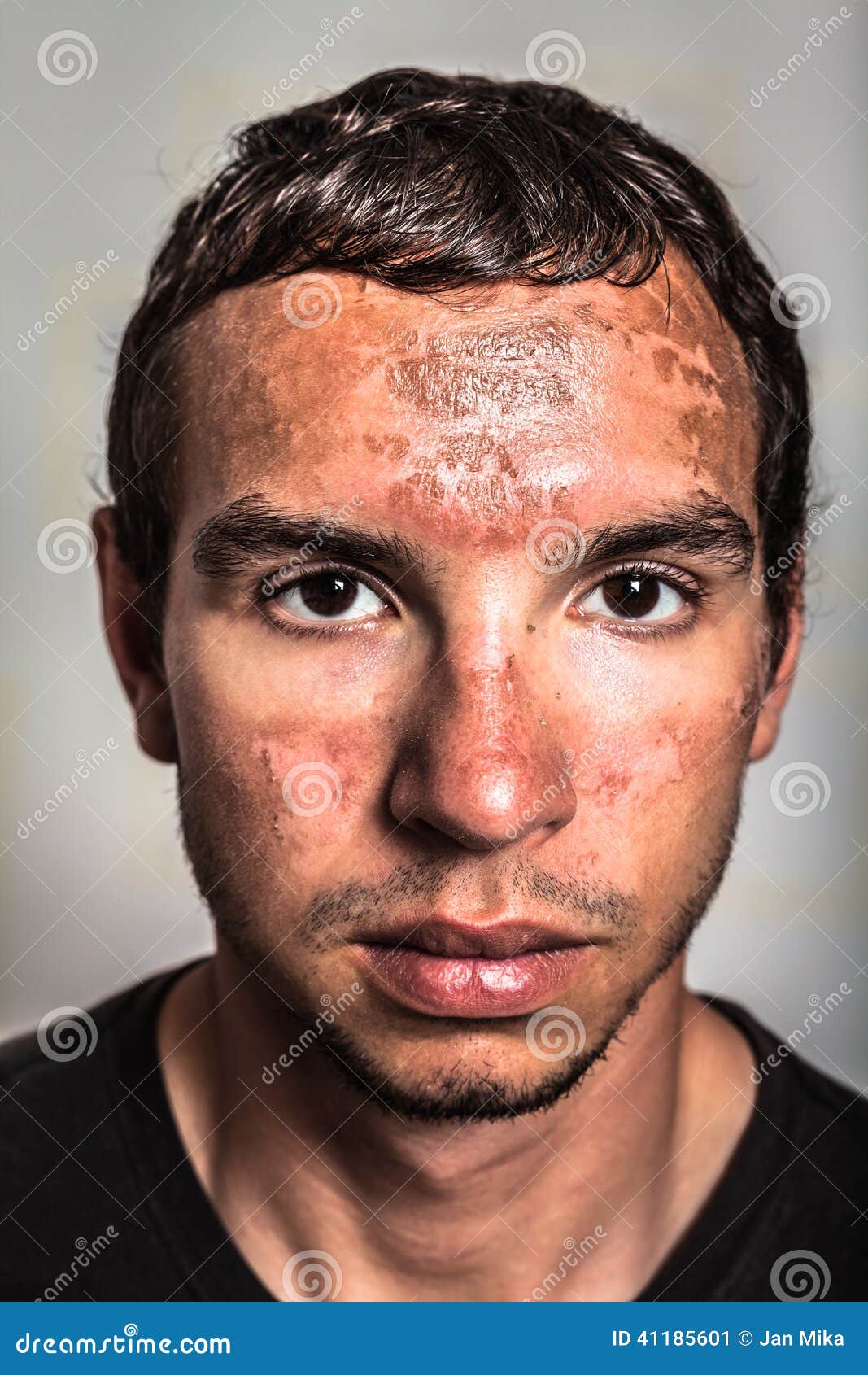 Sonnenbrandhaut Auf Mannlichem Gesicht Stockbild Bild Von Mannlichem Sonnenbrandhaut 41185601