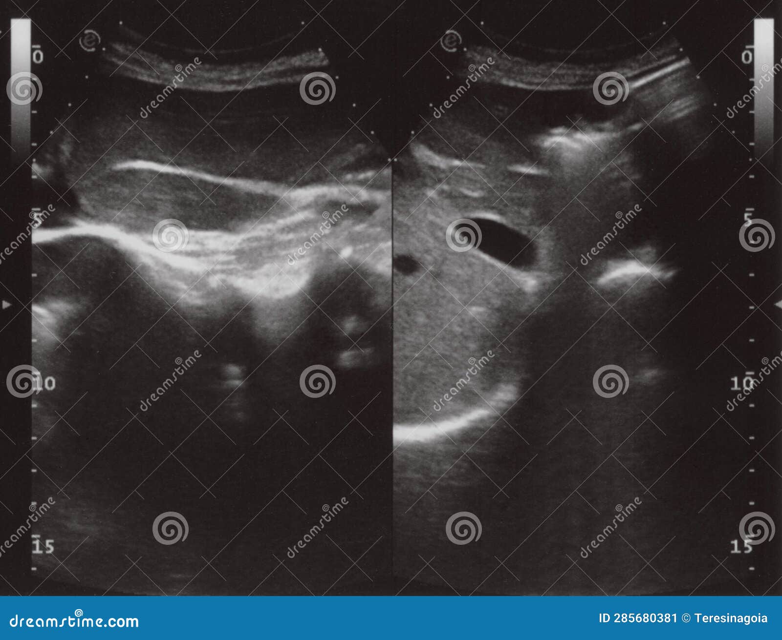 Sonograma Completo De Ultrasonido Abdomen Imagen de archivo - Imagen de