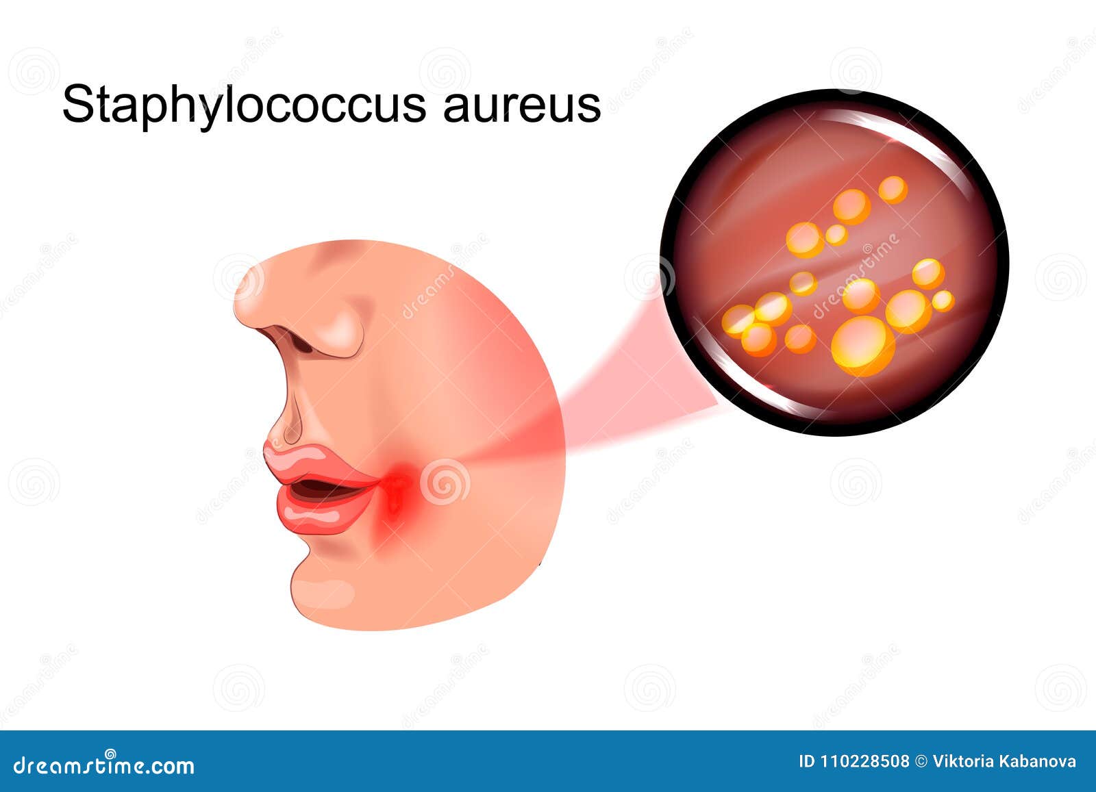 Sore On The Face. Staphylococcus Stock Vector ...
