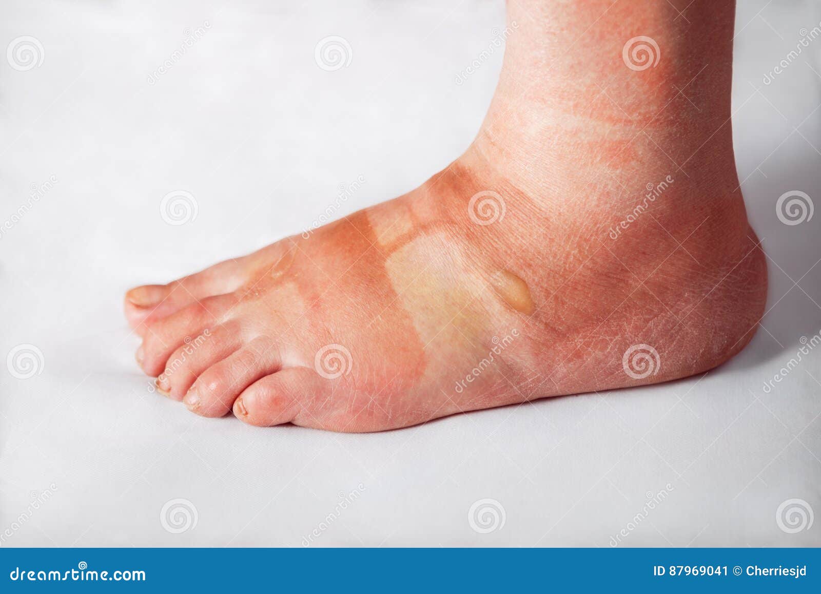 Sore foot with blisters stock image. Image of problem 87969041