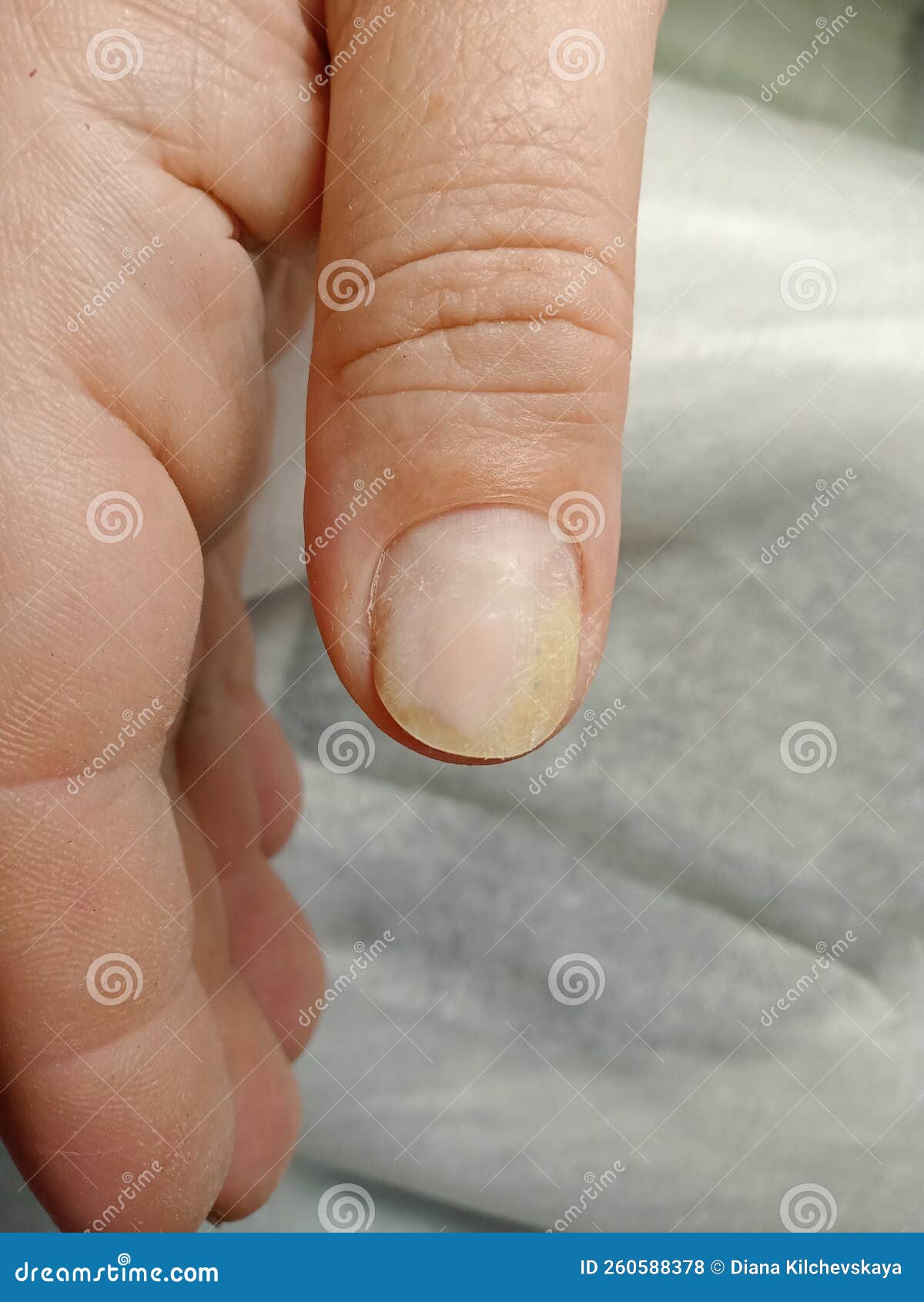 Sore nail , nail care stock photo. Image of nail, care 260588378