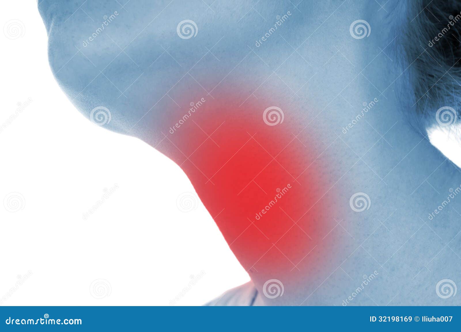 Sore throat, shown red stock image. Image of caucasian 32198169
