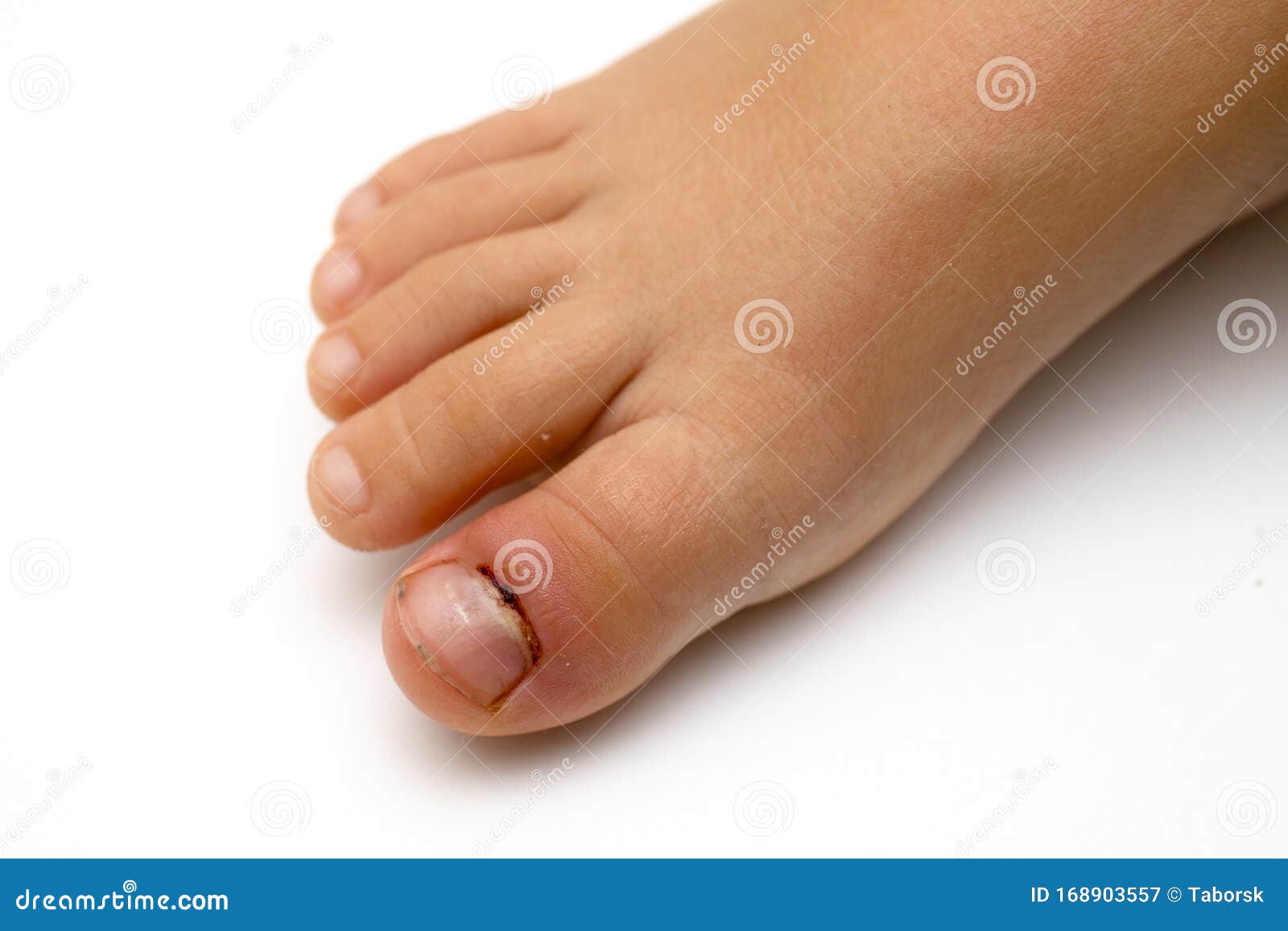 Acute Paronychia And Tinea Pedis At Big Toe Of Southeast Asian Elderly