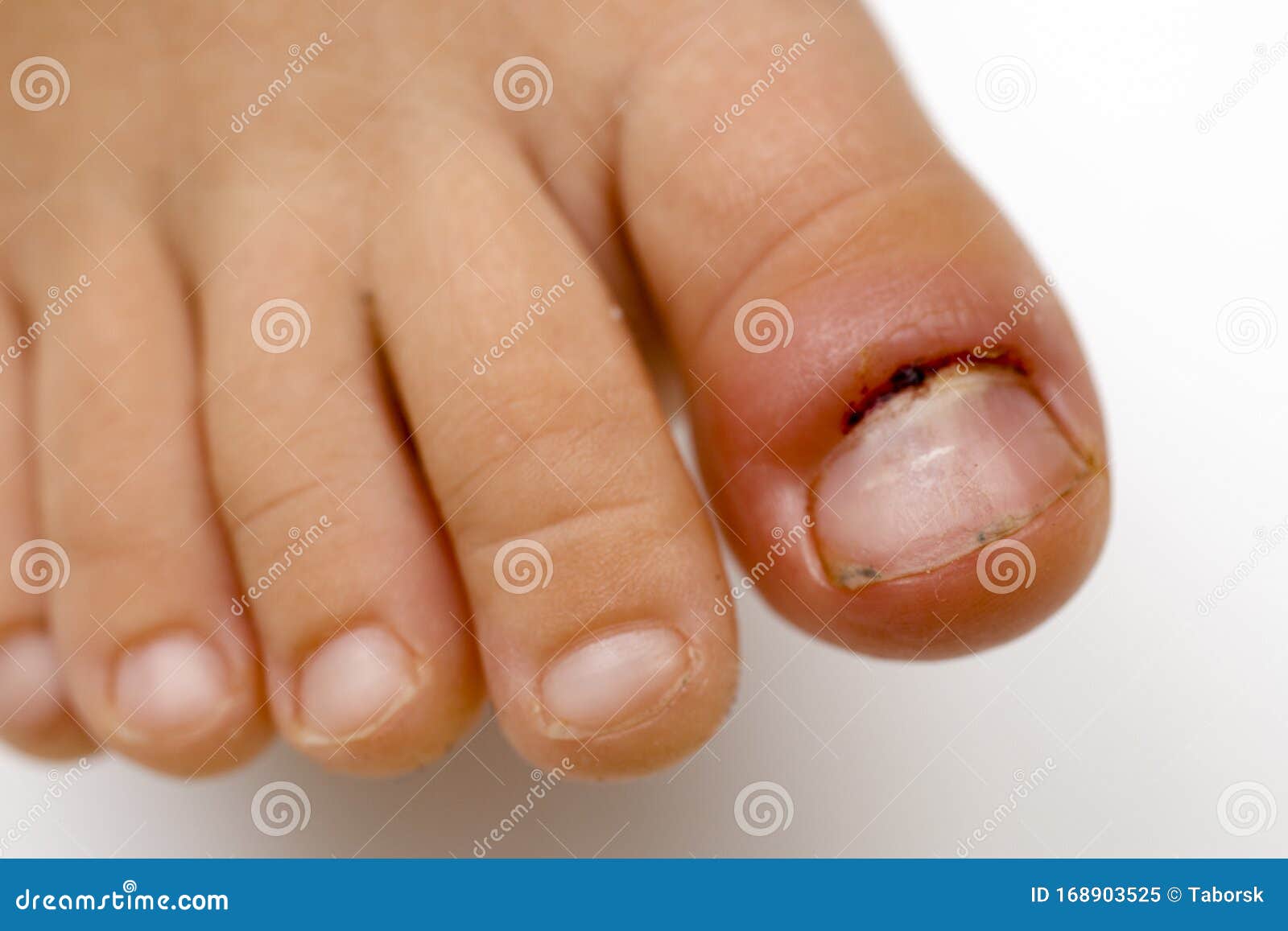 Acute Paronychia And Tinea Pedis At Big Toe Of Southeast Asian Elderly