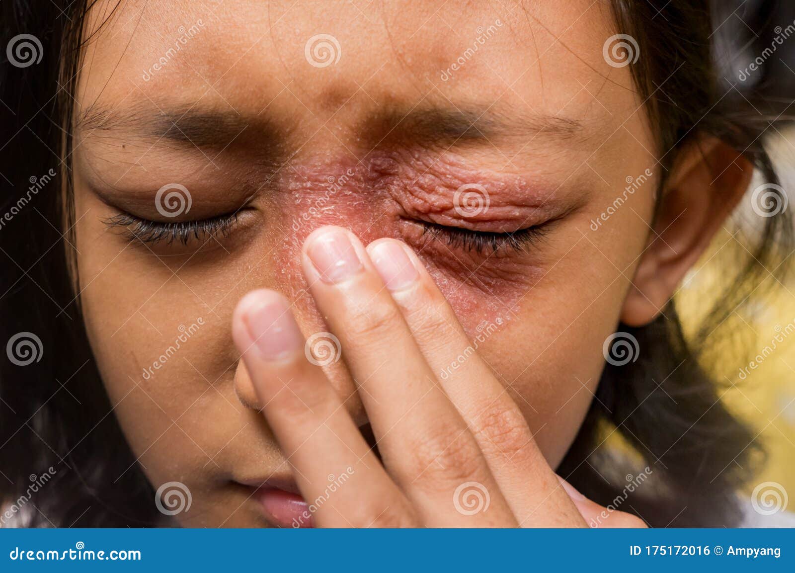 southeast asian ethnicity teenage girl annoyed with itchy skin disease, dermatitis problem on her face, scratching over it