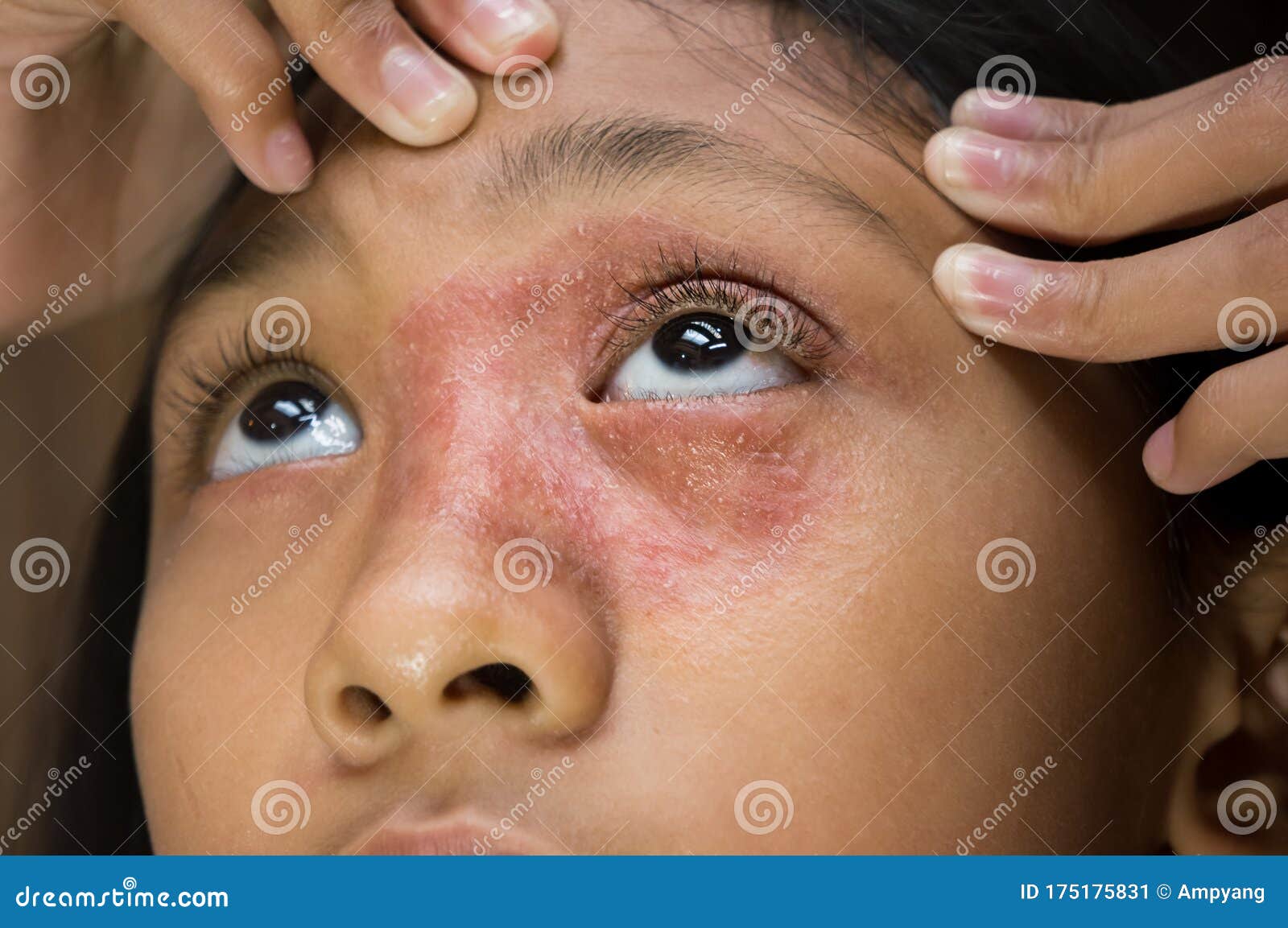 southeast asian ethnicity teenage girl with circular  dry skin rash on her face around the eye and nose, tinea corporis