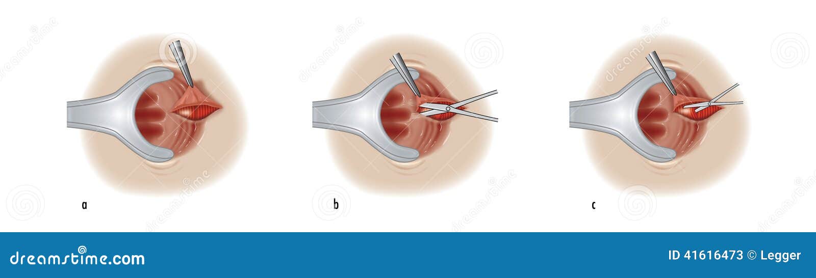 Sphincterotomy Procedure for Anal Fissure Stock Illustration - Illustration  of medicine, medical: 41616473
