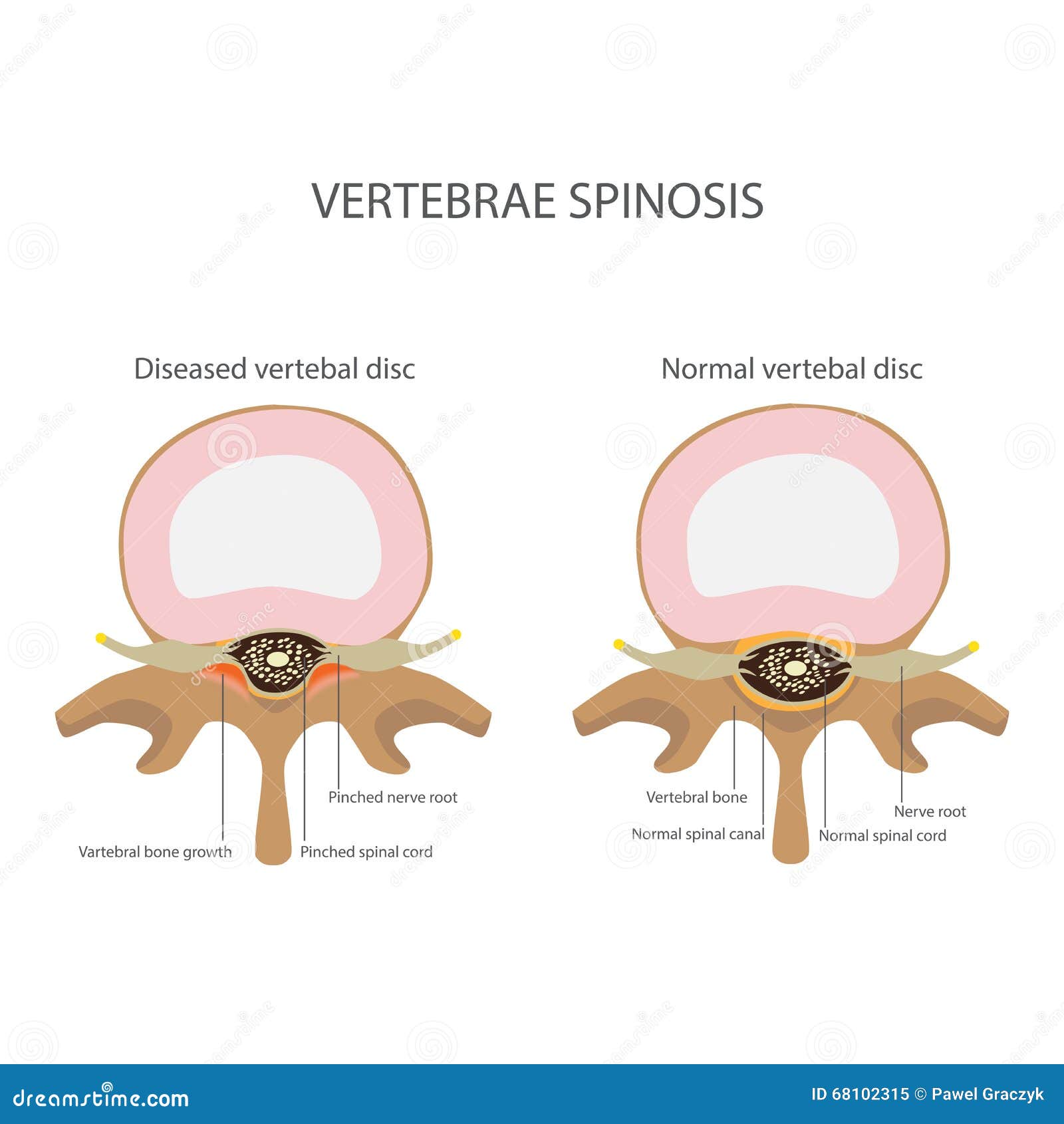 spin stenosis. vertebrae disease