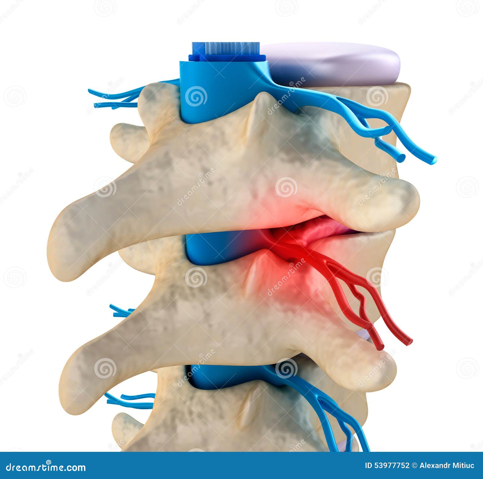 Spinal Cord Under Pressure of Bulging Disc Stock Illustration
