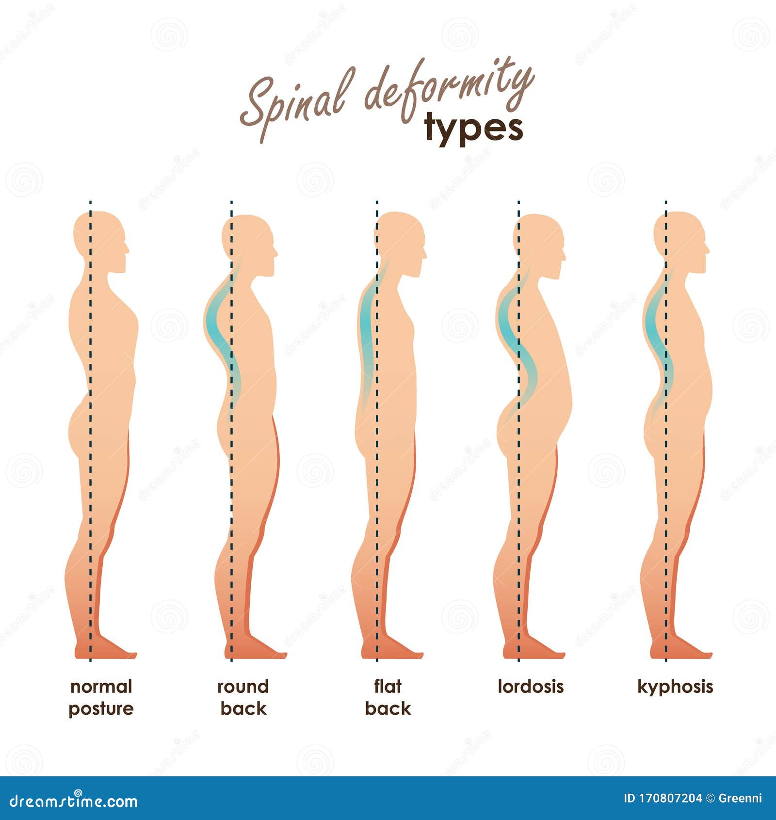 spinal deformity types. diseases of the spine.lordosis, kyphosis, round back, flat back.  human silhouettes