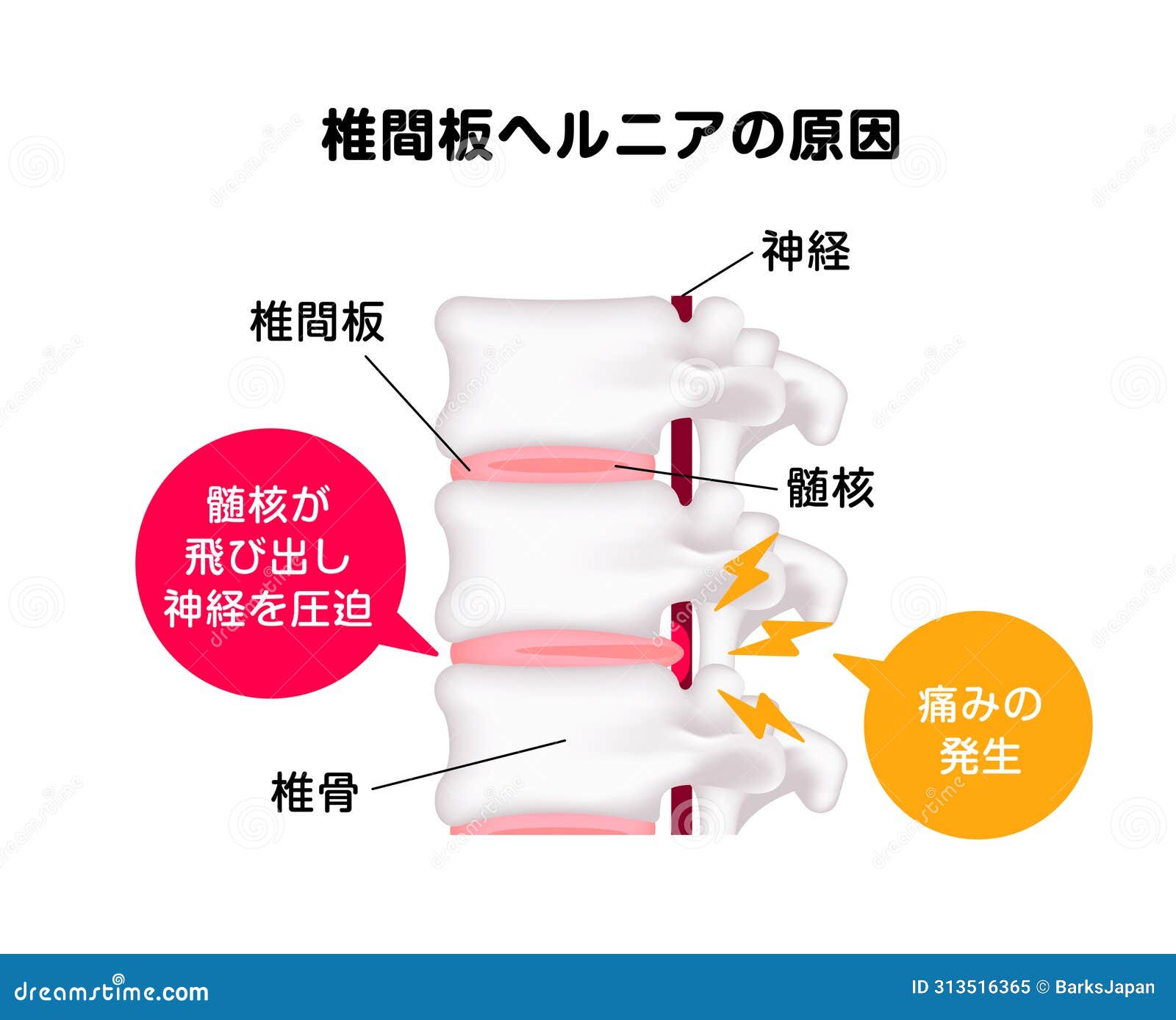 spinal-disc-herniation-illustration-cartoondealer-313516365
