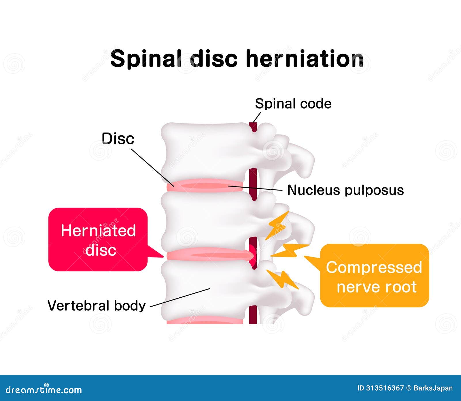 spinal disc herniation 