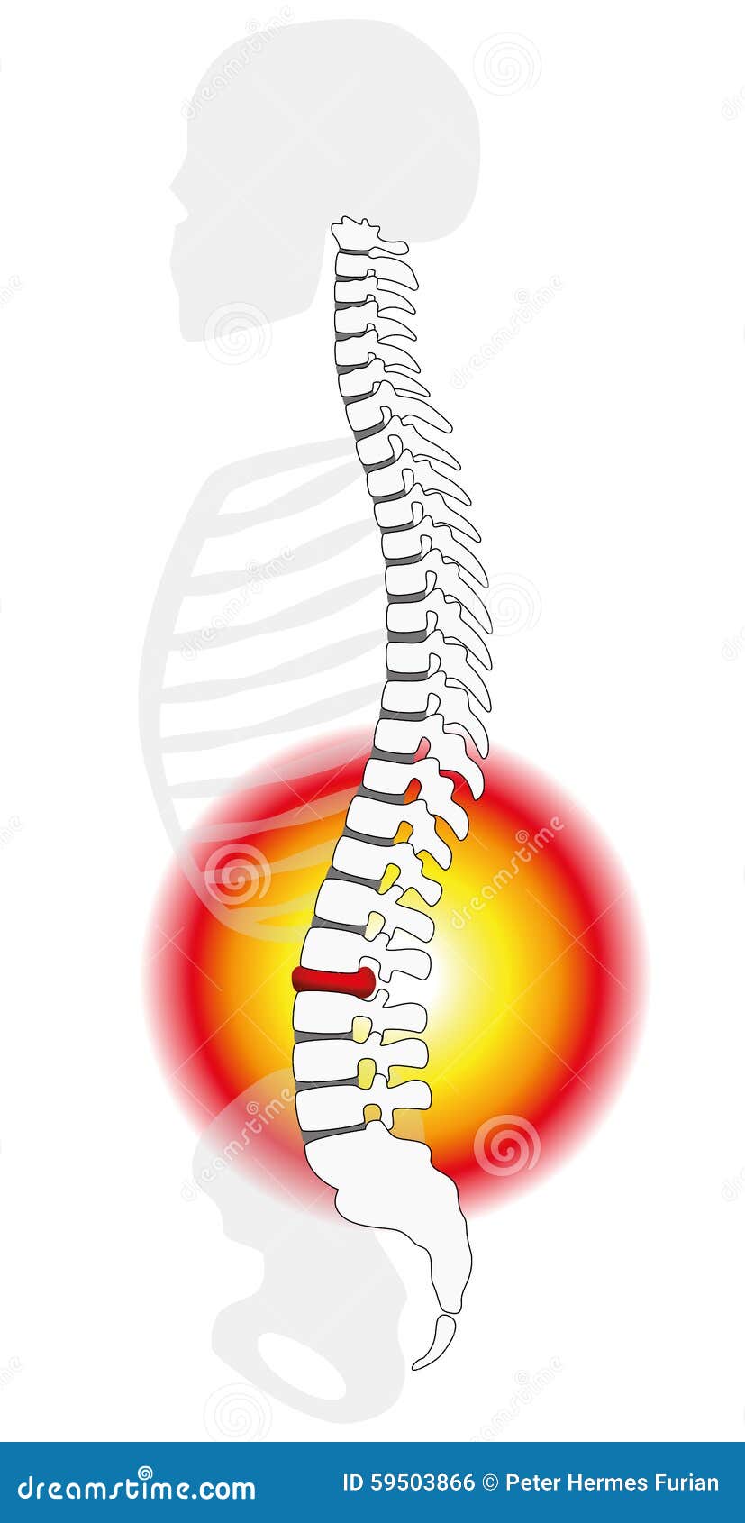 spinal disc prolapse herniation