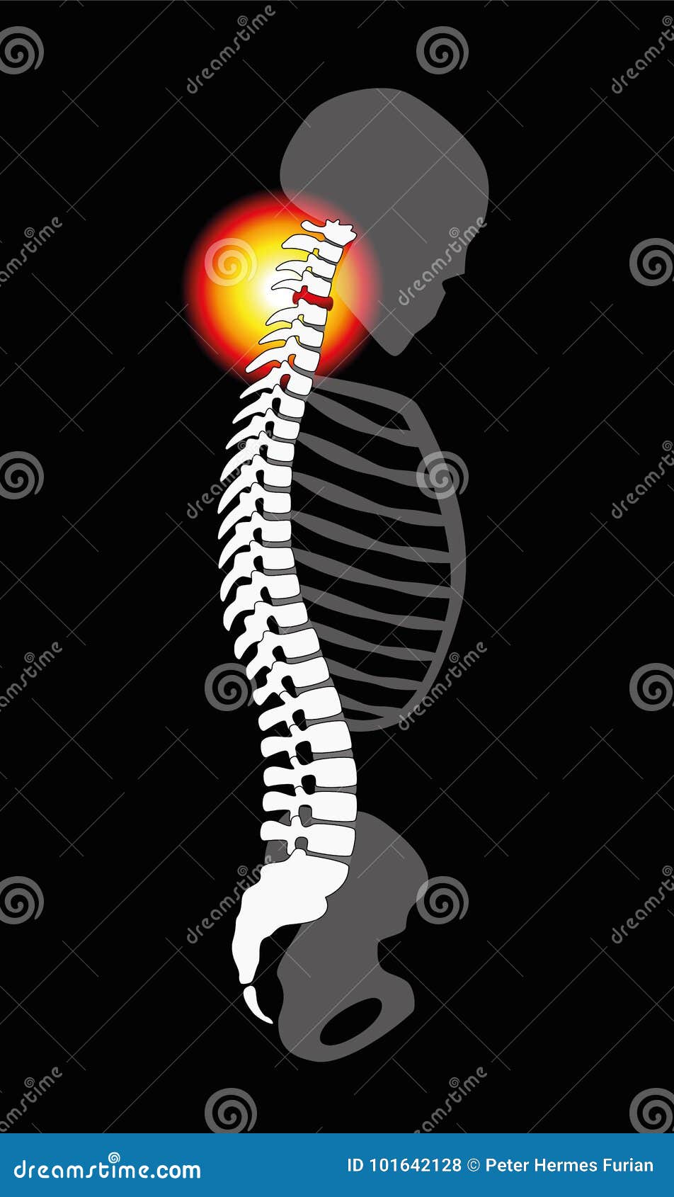 Spinal Disc Prolapse Neck Pain Cervical Vertebrae Stock Vector ...