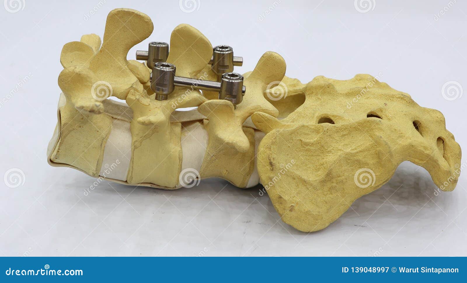 spinal fixation system - titanium bracket