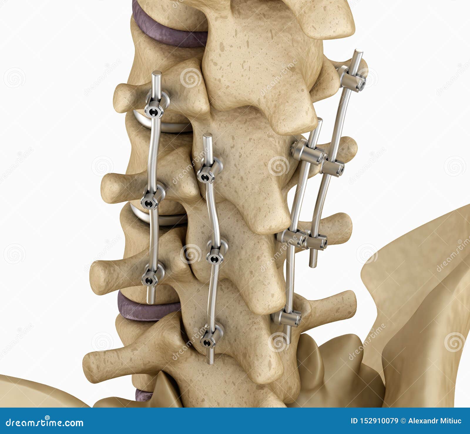 spinal fixation system - titanium bracket.