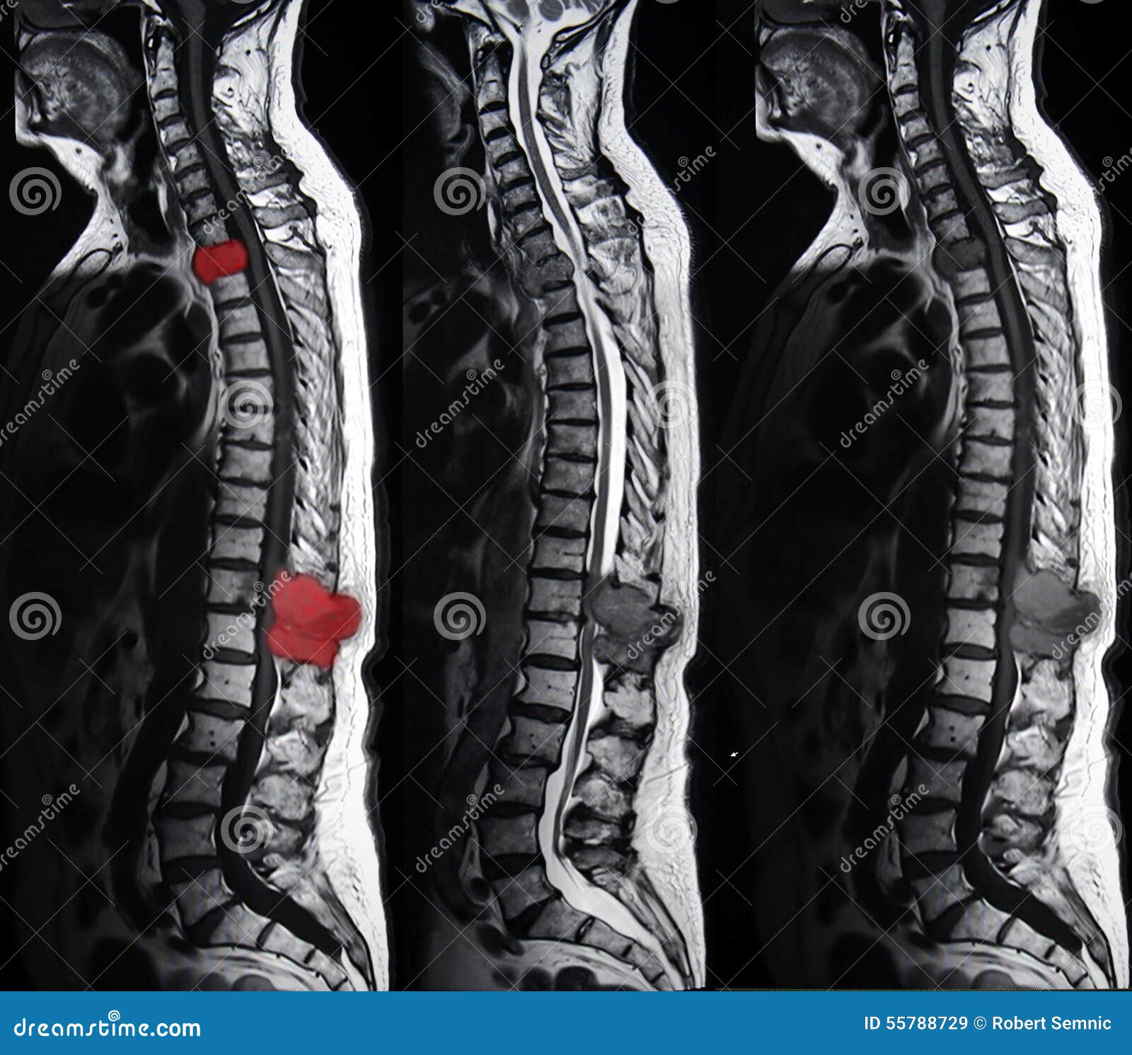 spine tumor