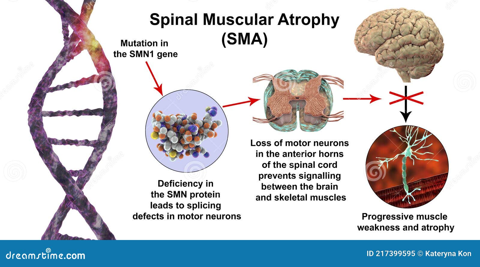 spinal muscular atrophy, sma, a genetic neuromuscular disorder with progressive muscle wasting