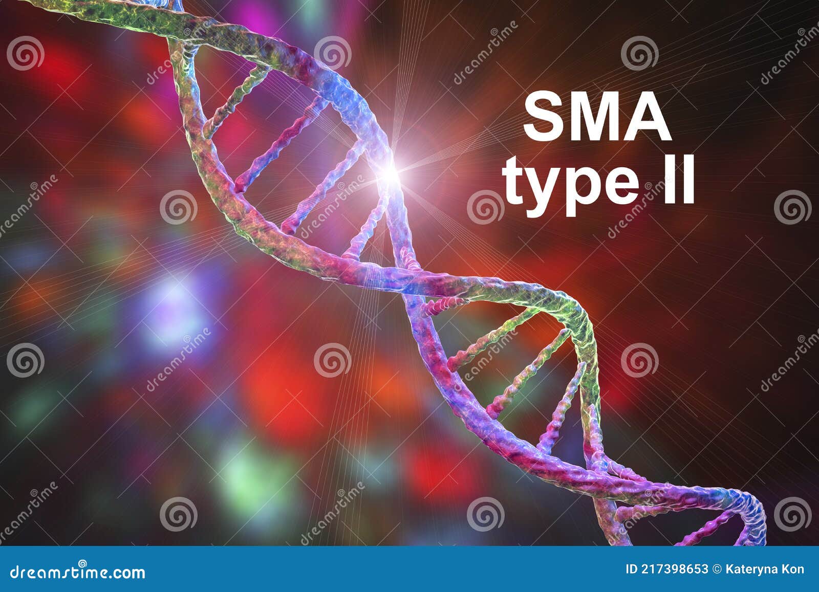 spinal muscular atrophy, sma, a genetic neuromuscular disorder