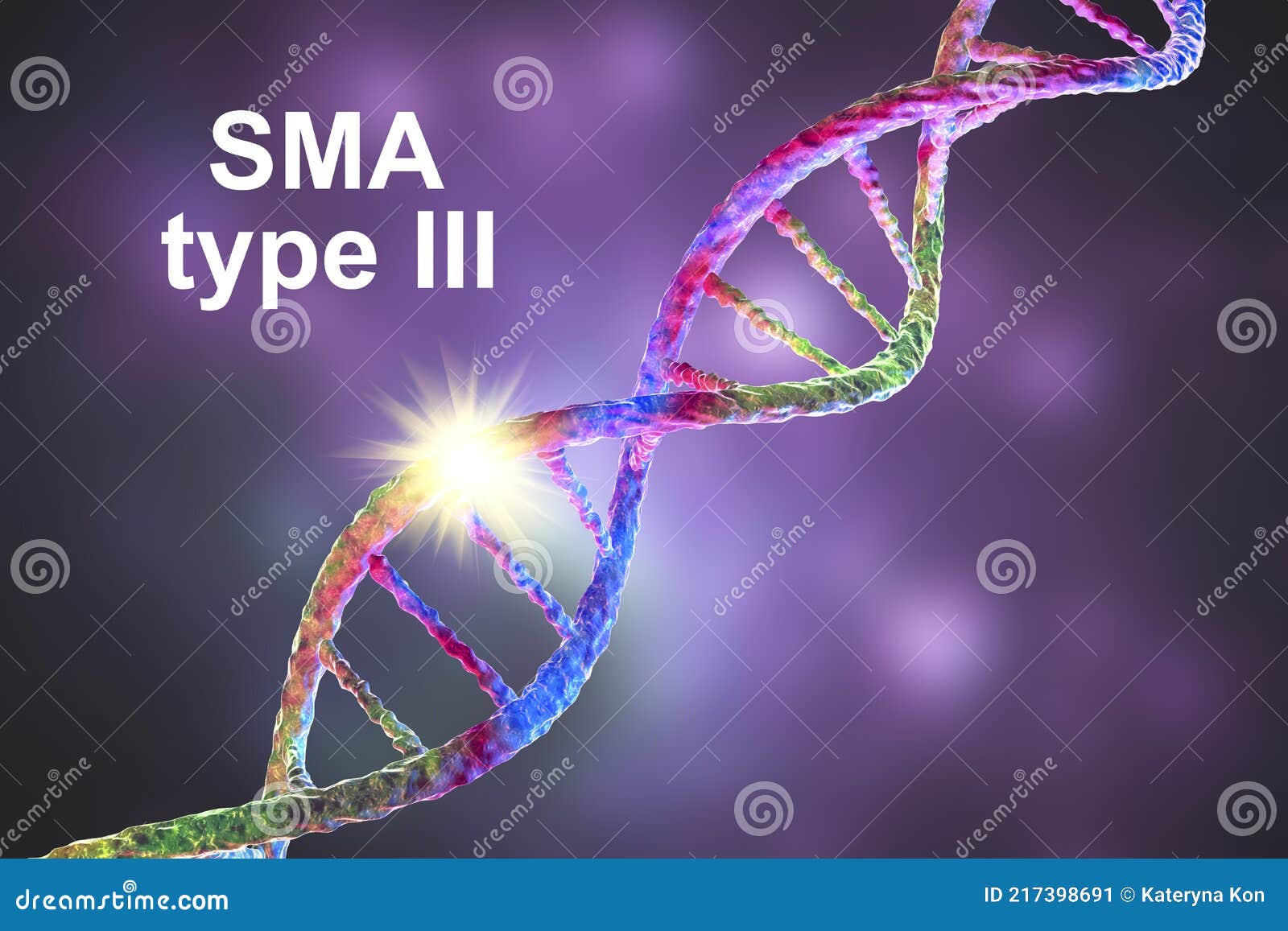 spinal muscular atrophy, sma, a genetic neuromuscular disorder