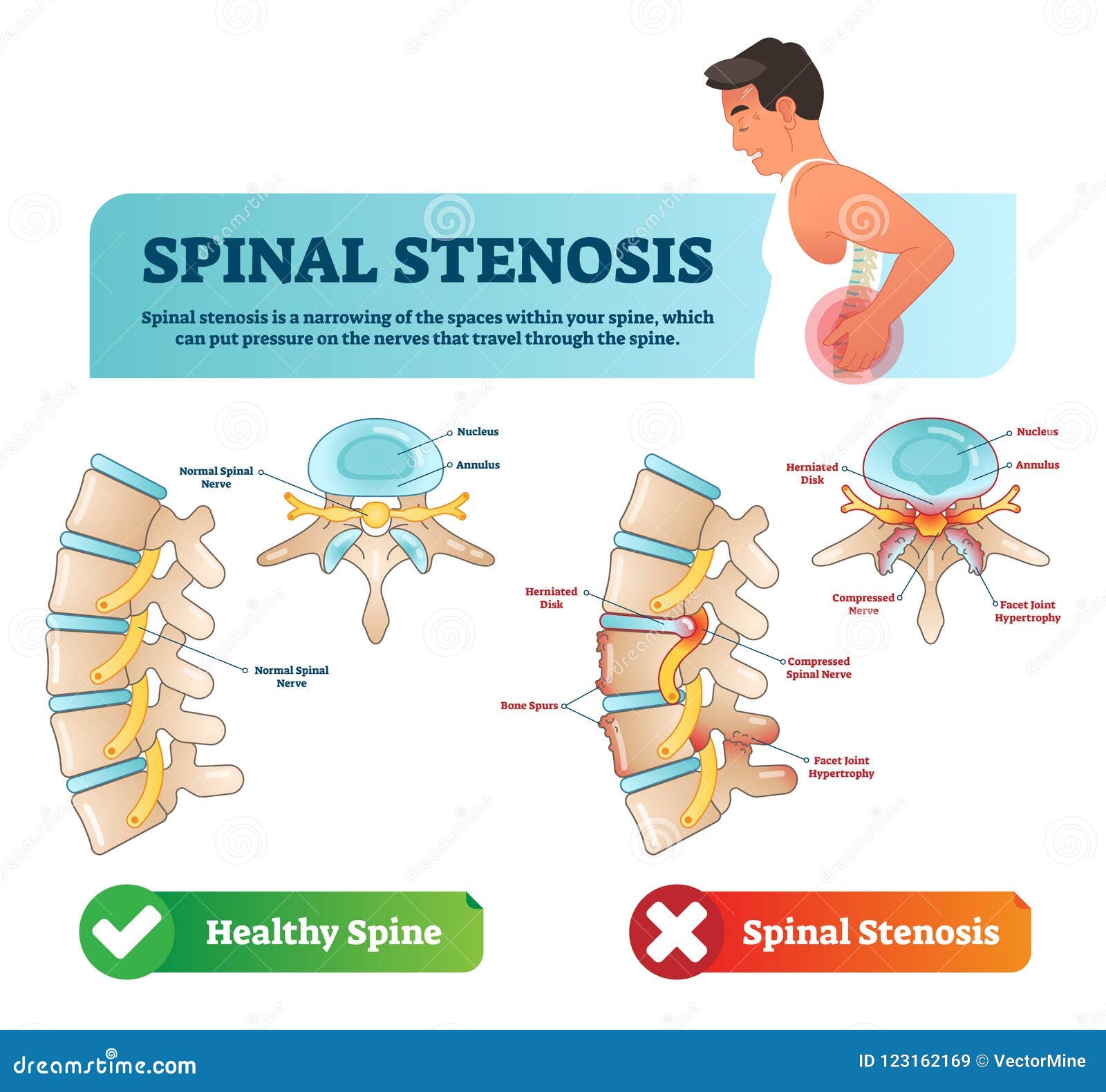 spinal stenosis  . labeled medical scheme. diagram with nucleus, annulus, bone spurs and compressed spinal nerve
