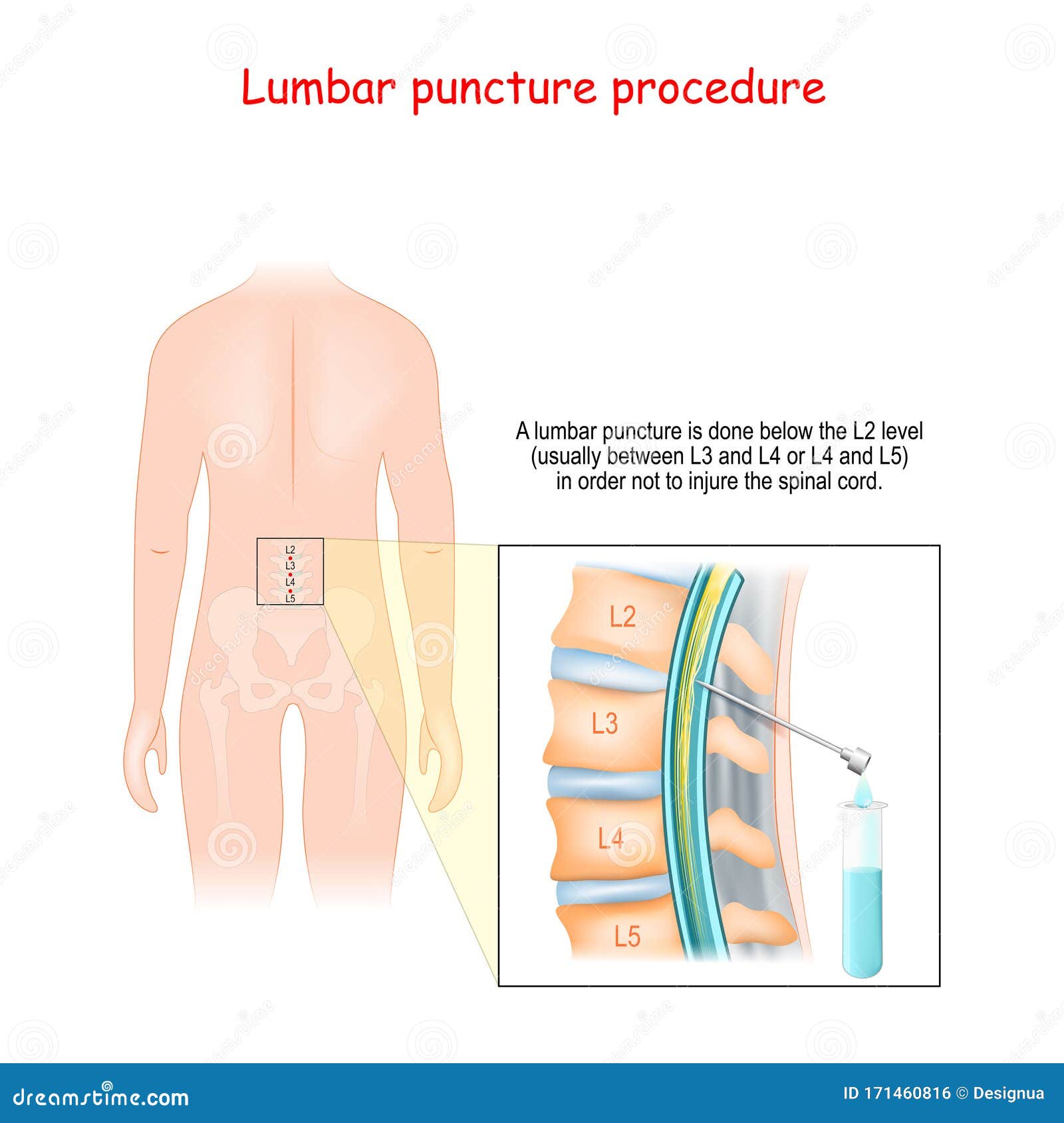 spinal tap procedure spinal tap procedure