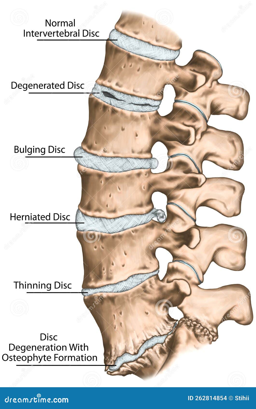 board 1 degenerative lumbar disc disease