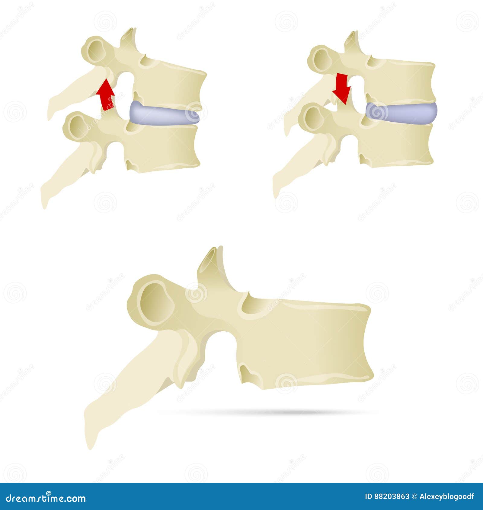 spine, lumbar vertebra. facet syndrome, advanced uncovertebral a