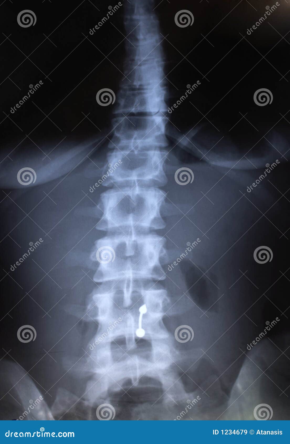 spine radiography - x rays