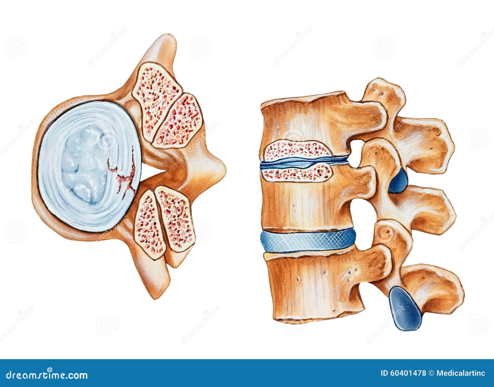 spine - spinal stenosis