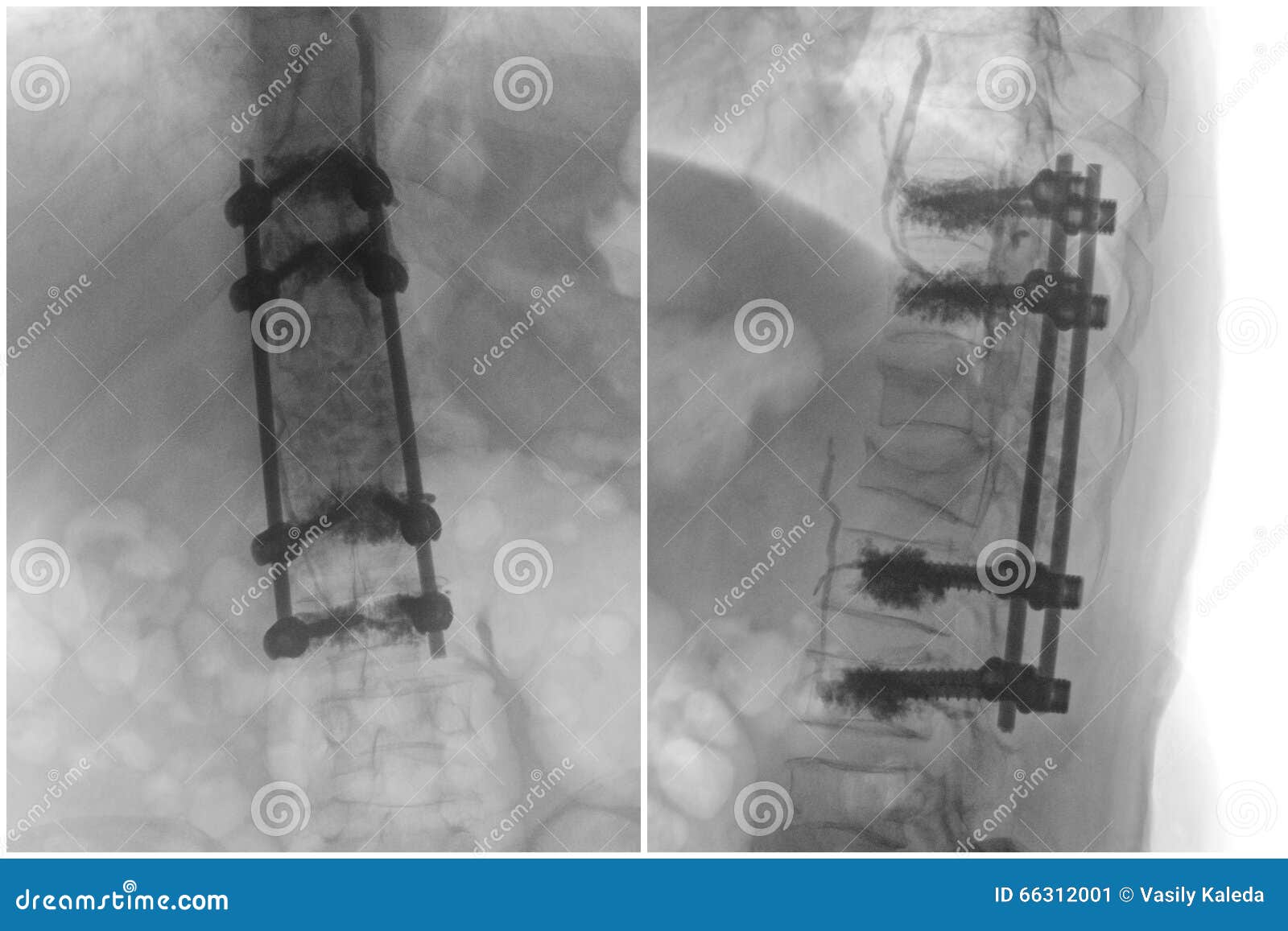 Операция на позвоночнике болит нога