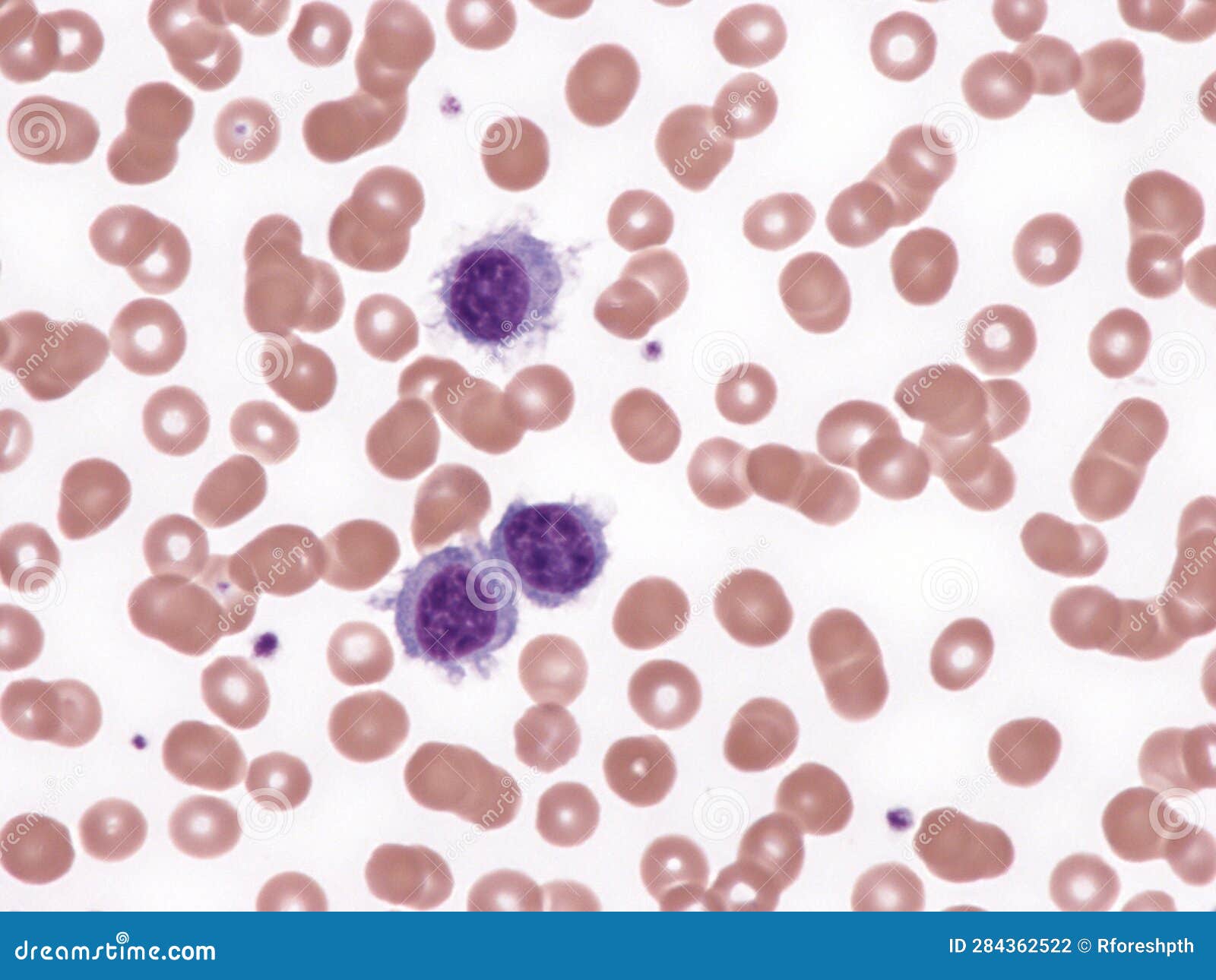 Splenic Lymphoma with Villous Lymphocytes. Stock Photo - Image of ...