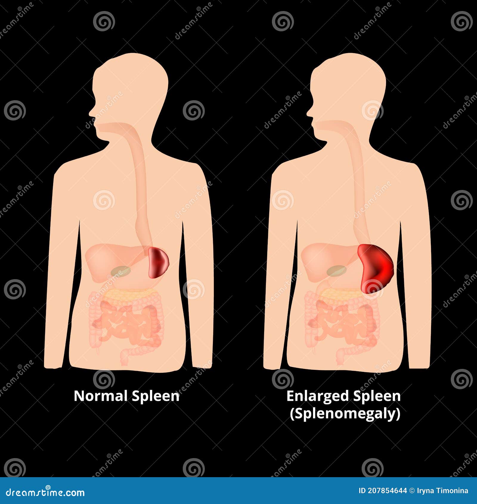 normal and enlarged spleen