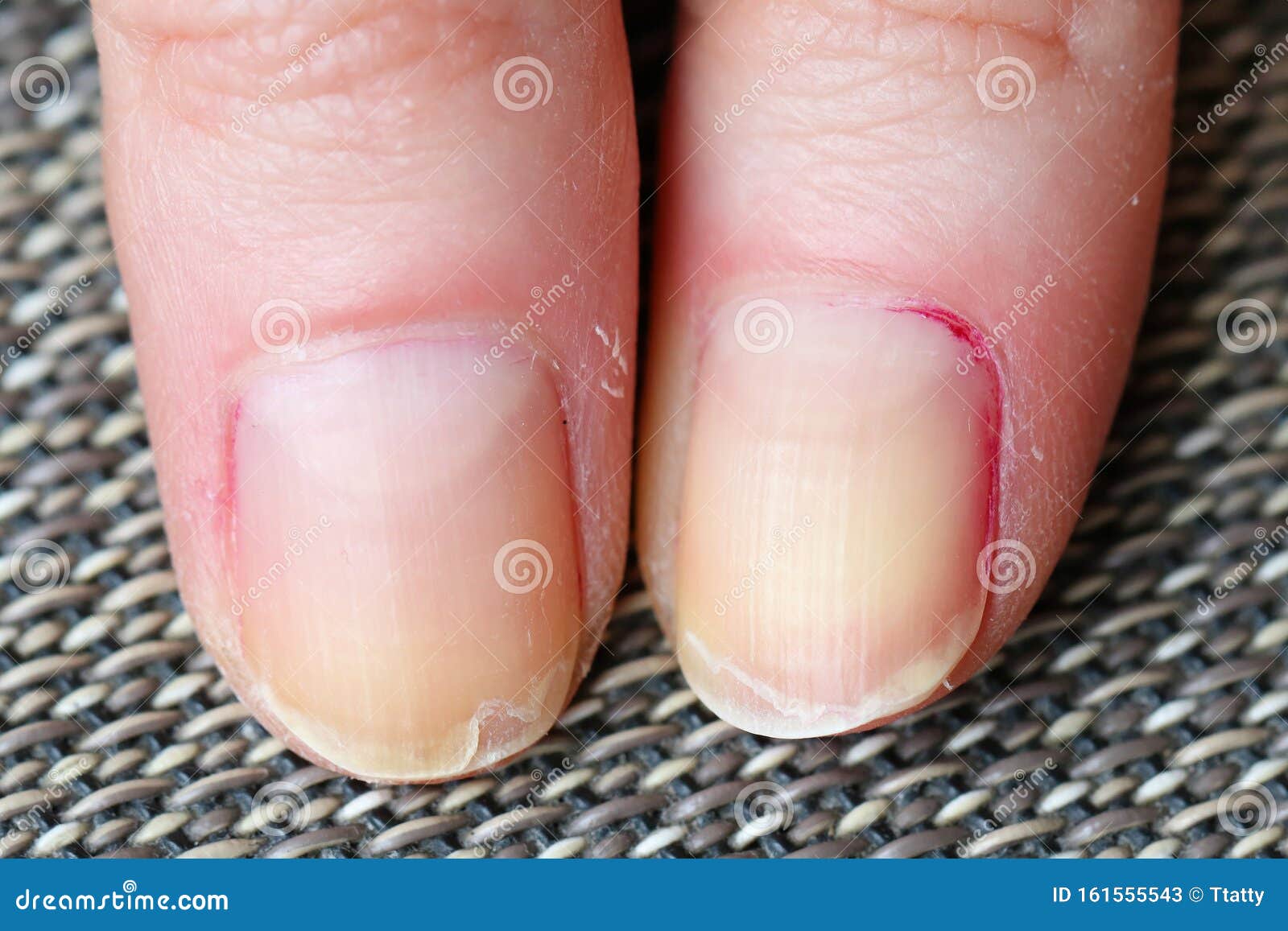 154 Dry Brittle Nails Stock Photos - Free & Royalty-Free Stock Photos from  Dreamstime