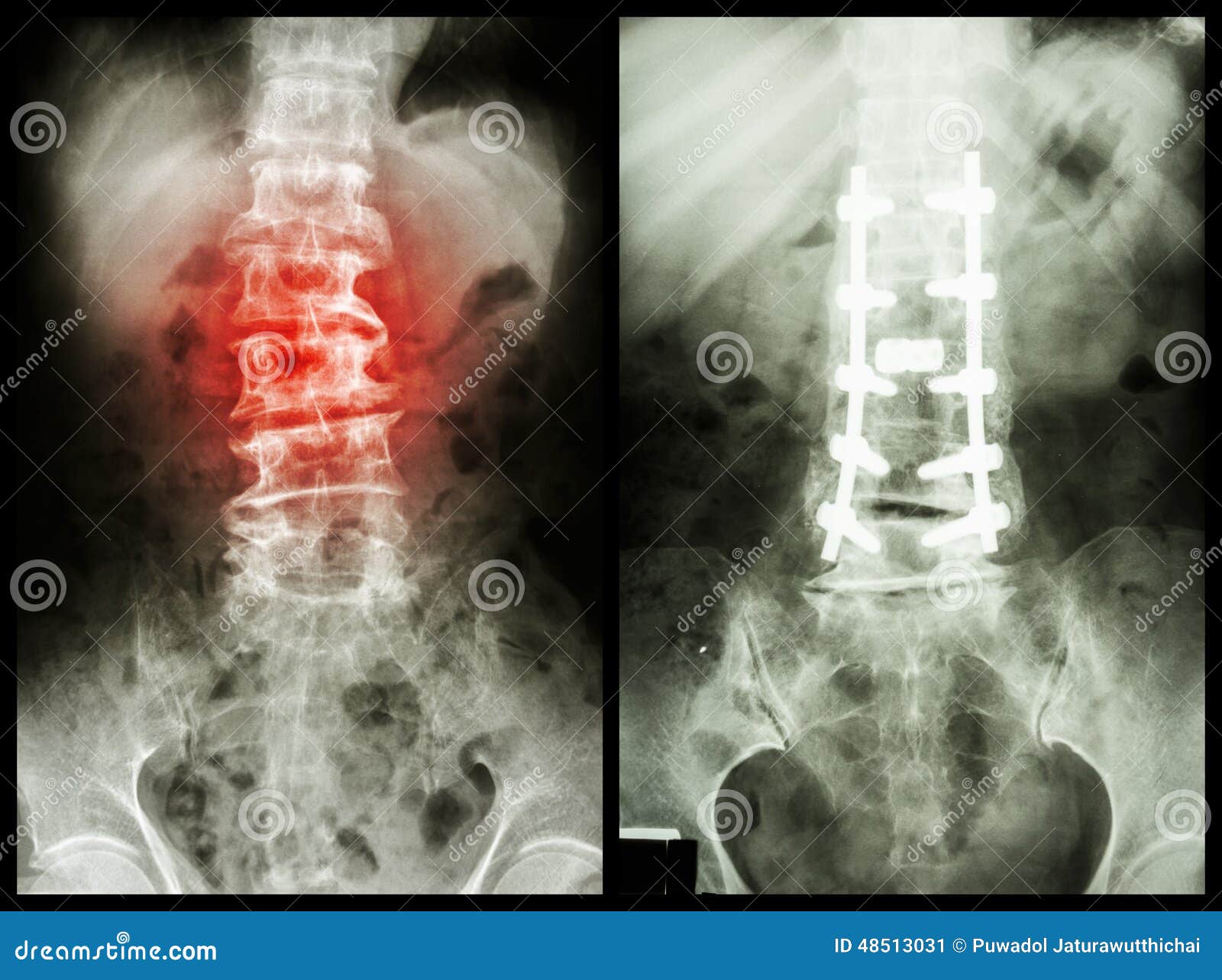 spondylosis (left image) , patient was operated and internal fixed. (right image)