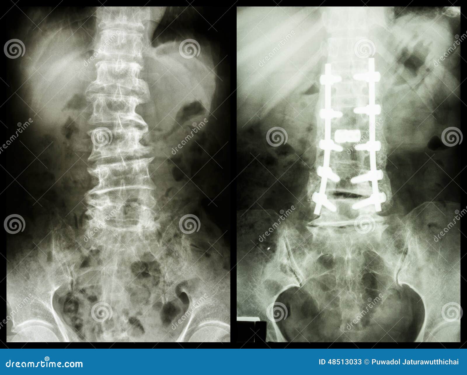 spondylosis (left image) , patient was operated and internal fixed. (right image)