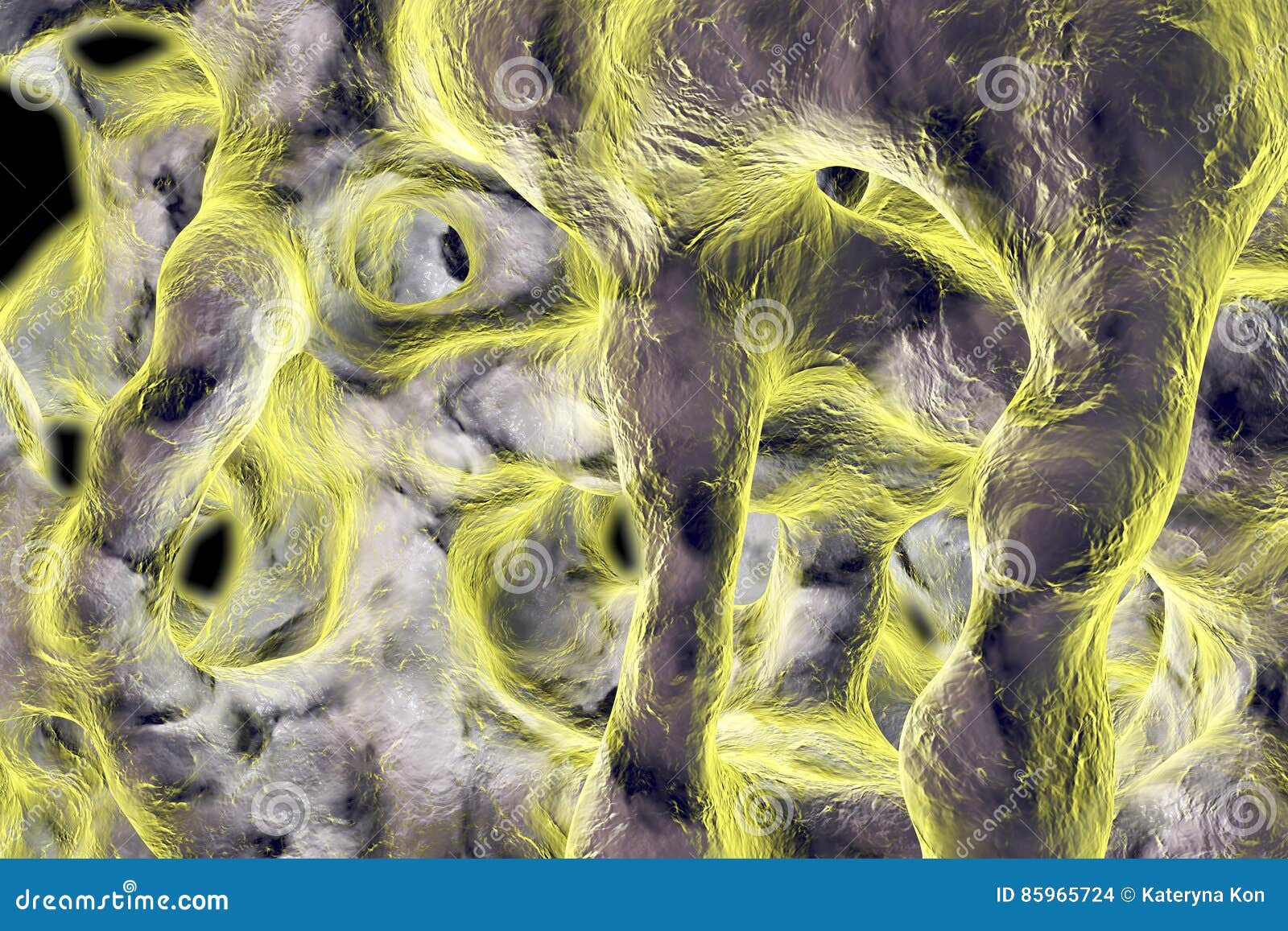 Spongy Bone Tissue Affected By Osteoporosis Stock Illustration