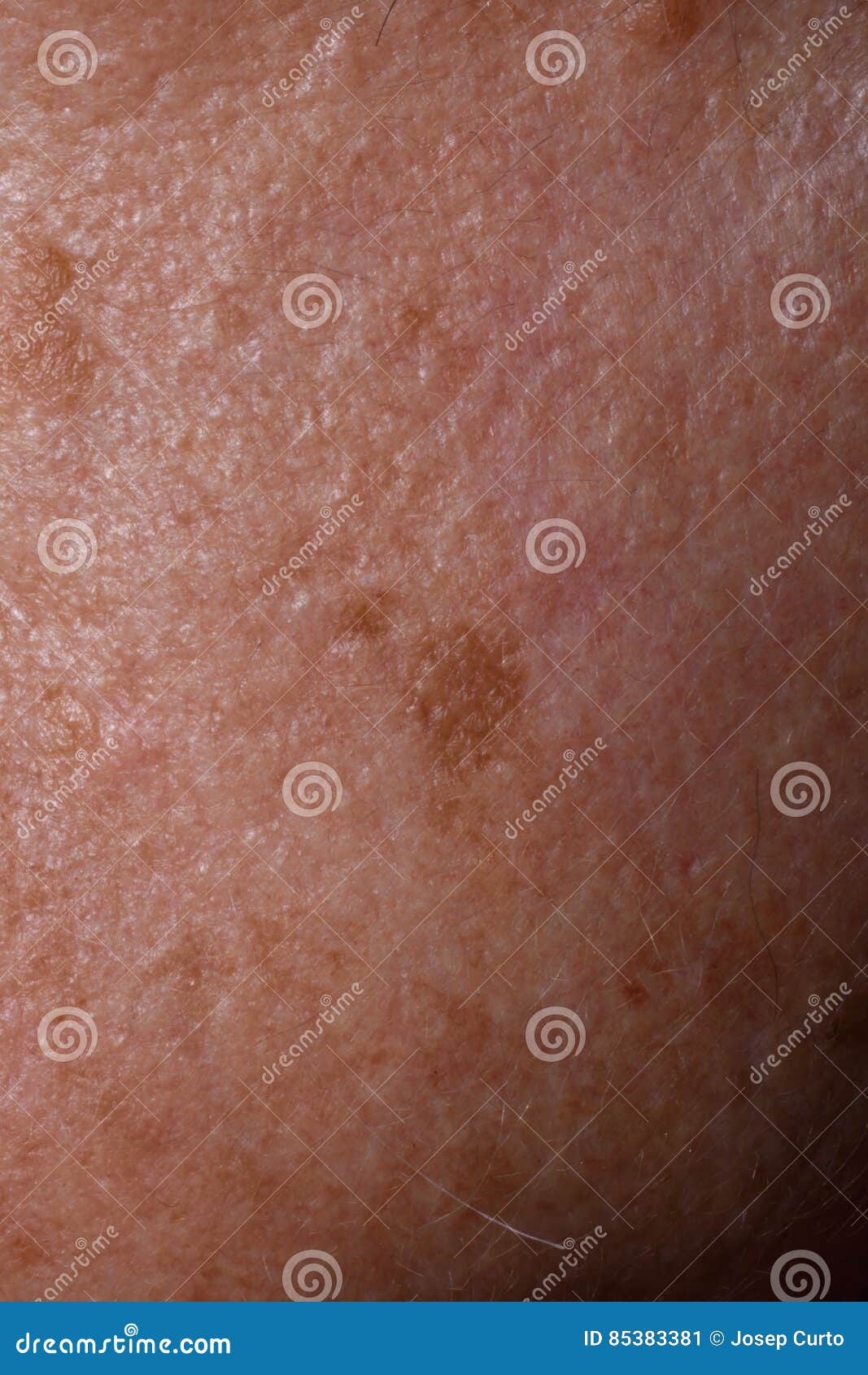 Spots Stock Image Image Of White Person Liver Dark 85383381