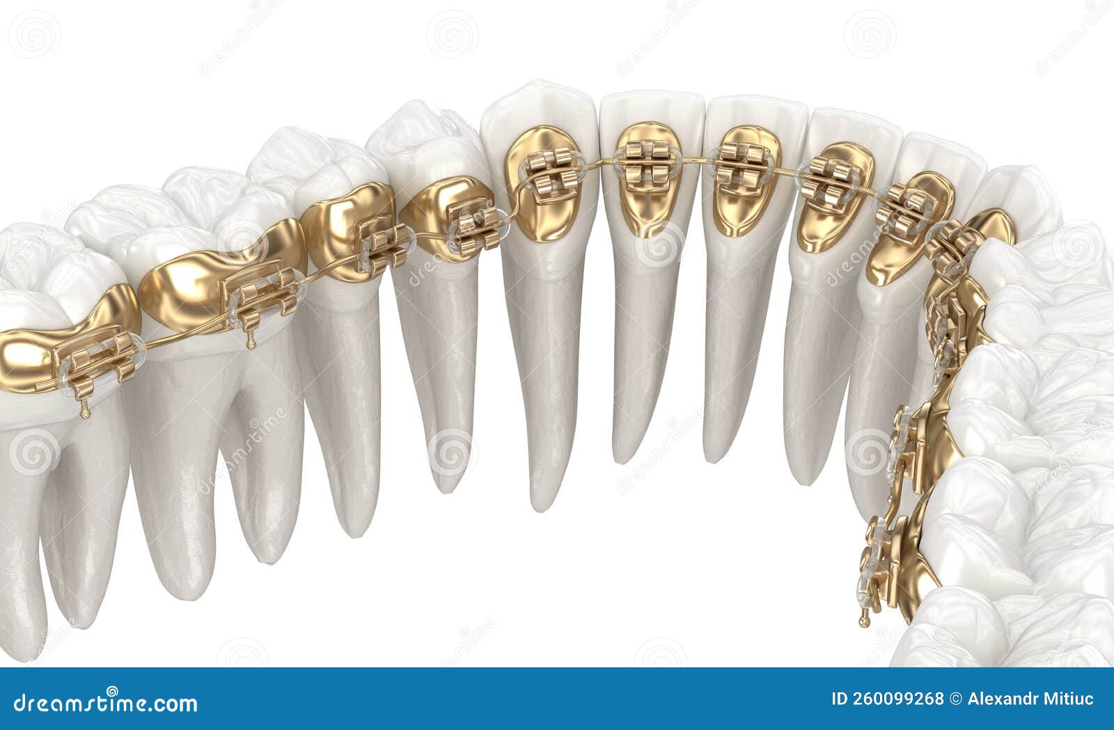 Sprachspange System 3D-Darstellung Des Konzepts Der Goldenen Spangen Stock  Abbildung - Illustration von zahnmedizinisch, obacht: 260099268