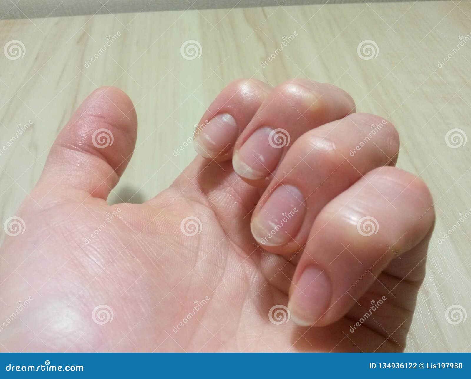 Why do my nails have white spots? : r/nailbiting