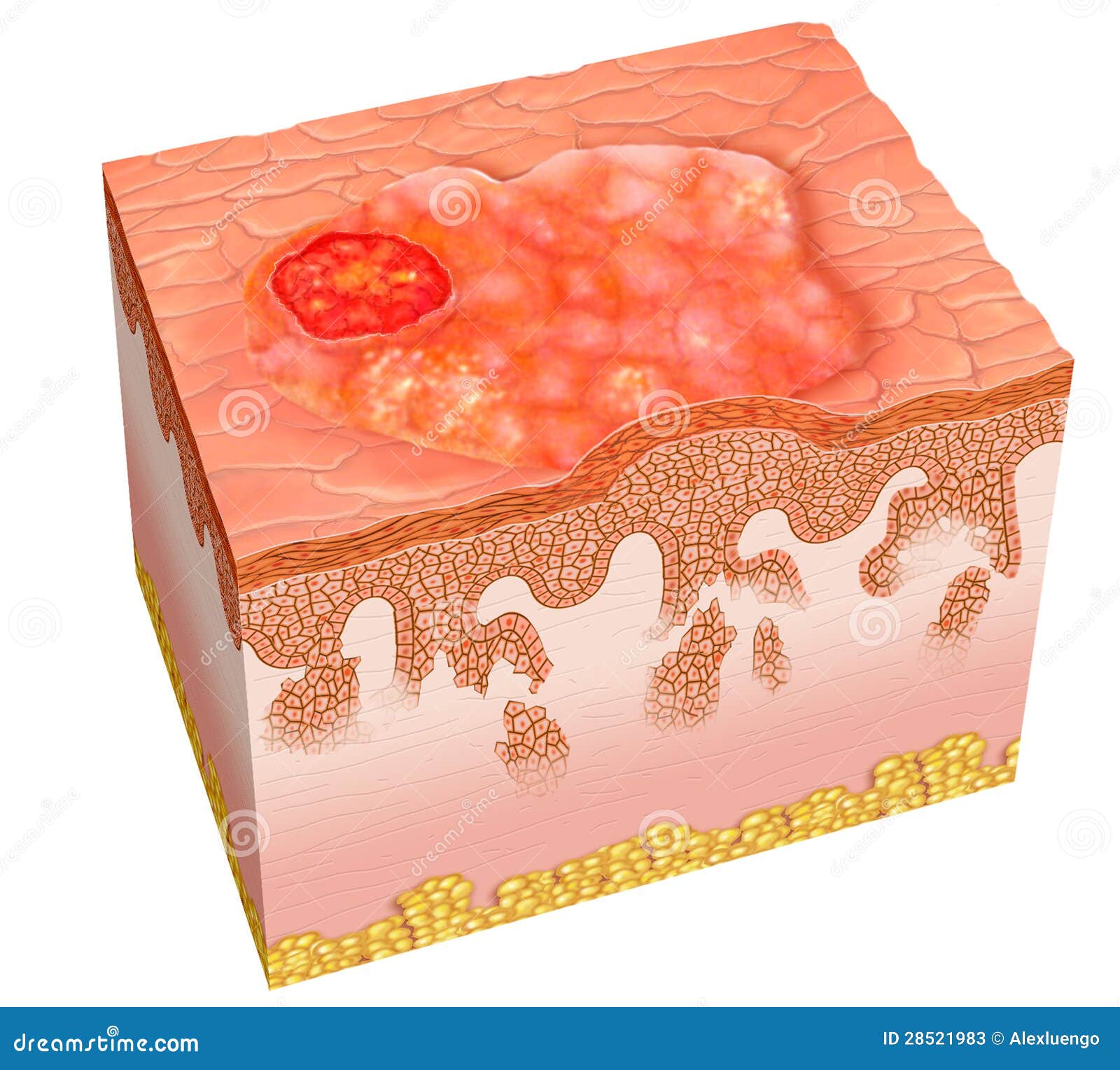 Squamous cell carcinoma stock illustration. Illustration of trunk ...