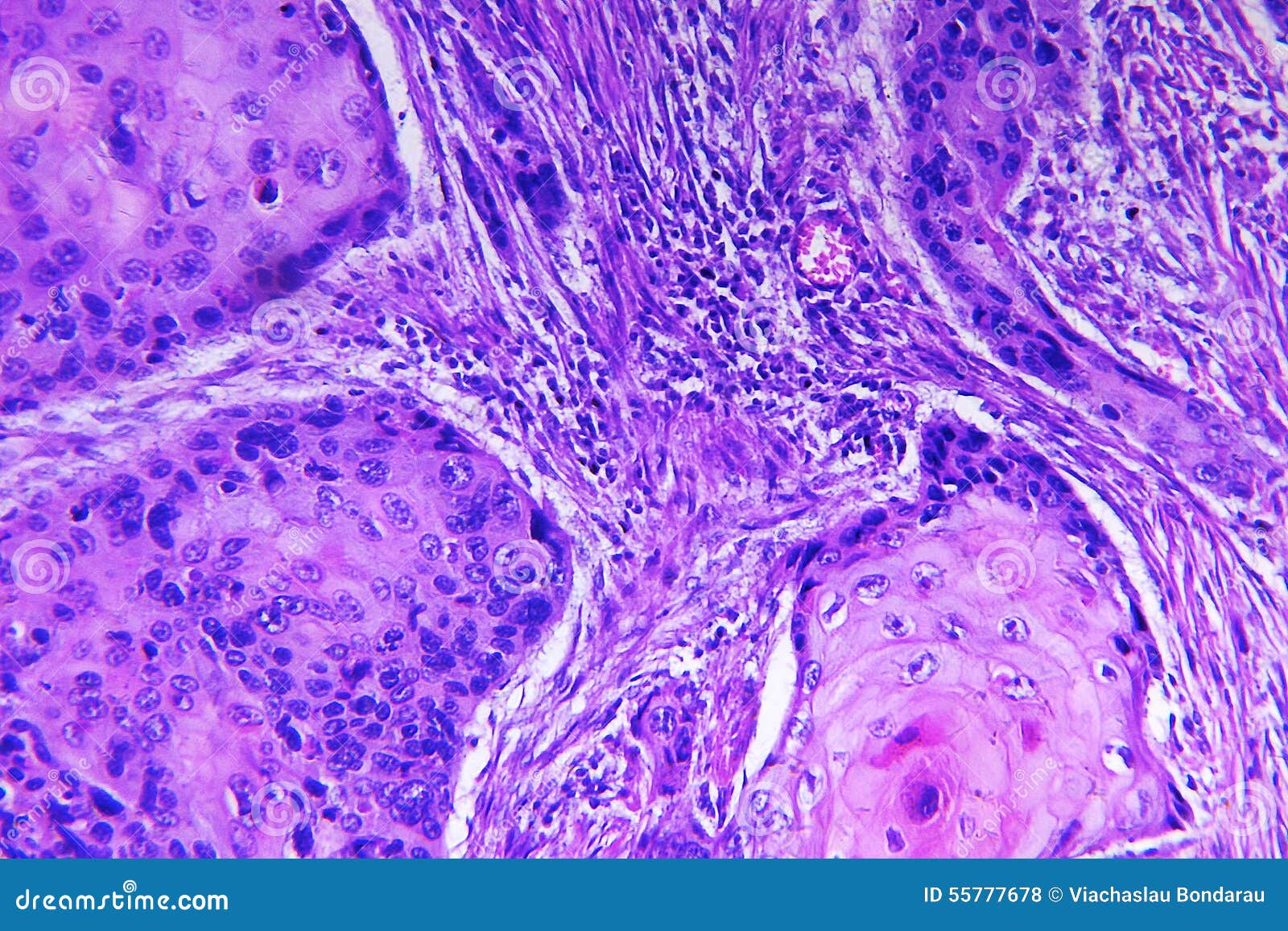 squamous cell carcinoma of a human